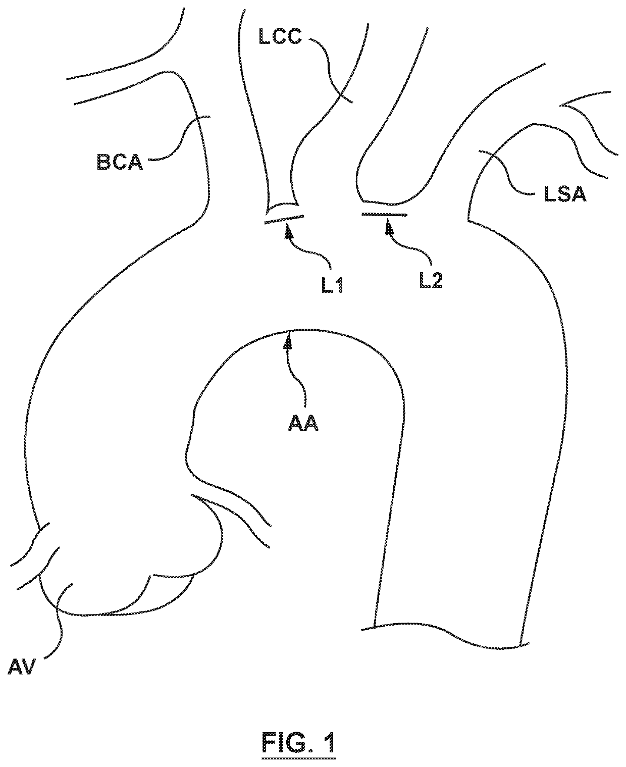 Modular aortic arch prosthetic assembly and method of use thereof