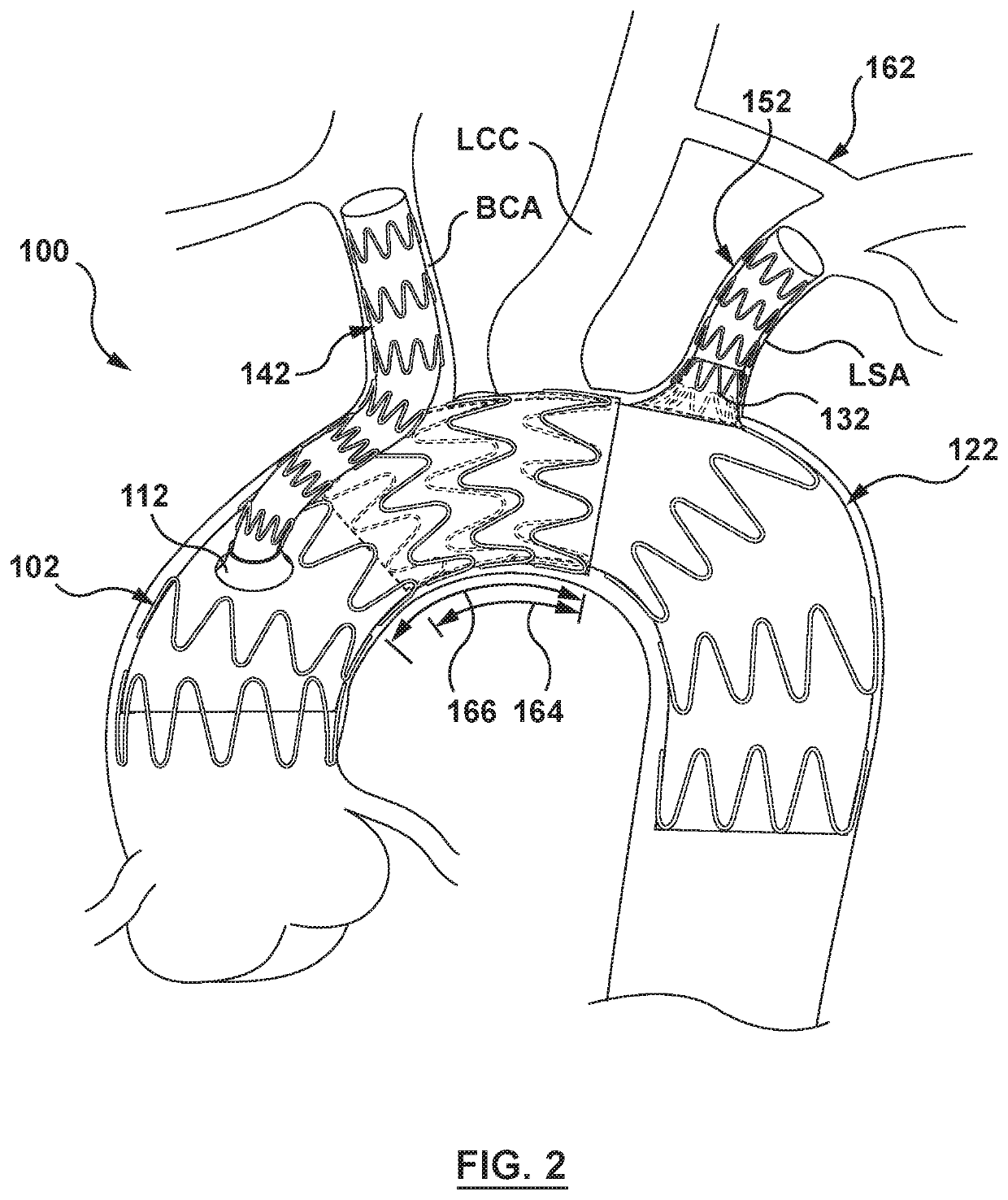 Modular aortic arch prosthetic assembly and method of use thereof