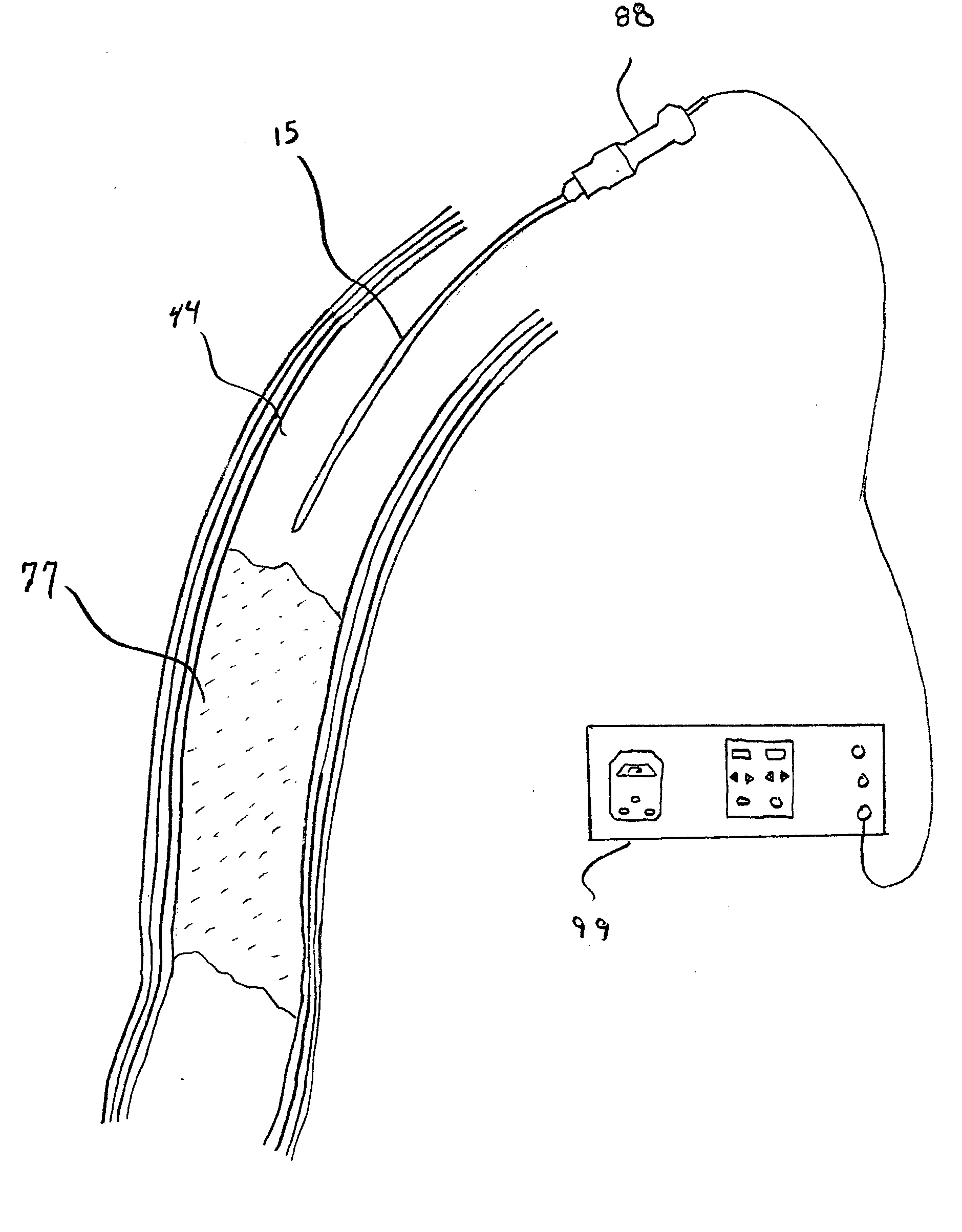 Apparatus and method for an ultrasonic medical device to treat chronic total occlusions