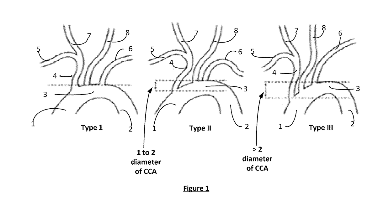 Apparatus and method for a bifurcated catheter for use in hostile aortic arches