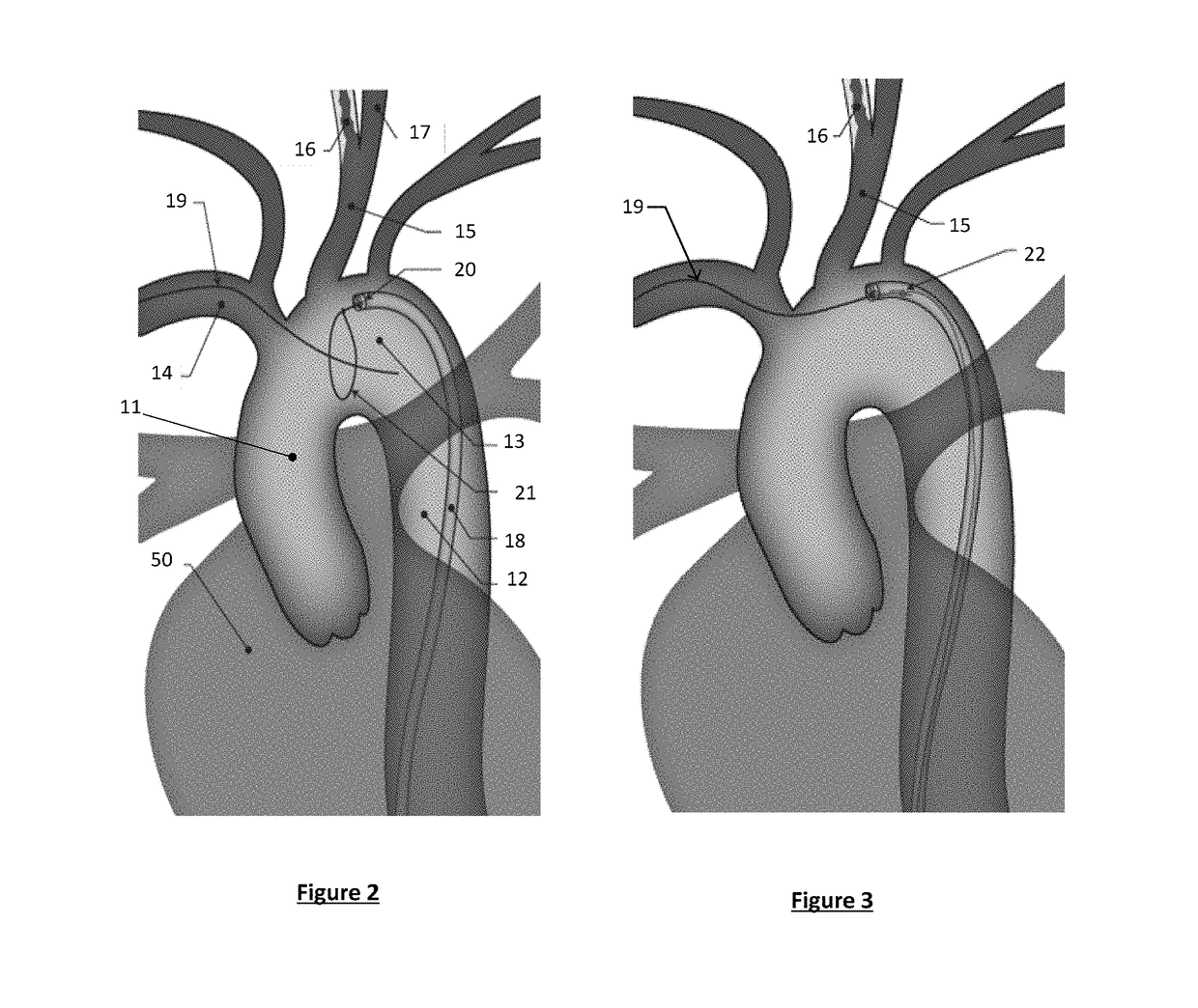 Apparatus and method for a bifurcated catheter for use in hostile aortic arches