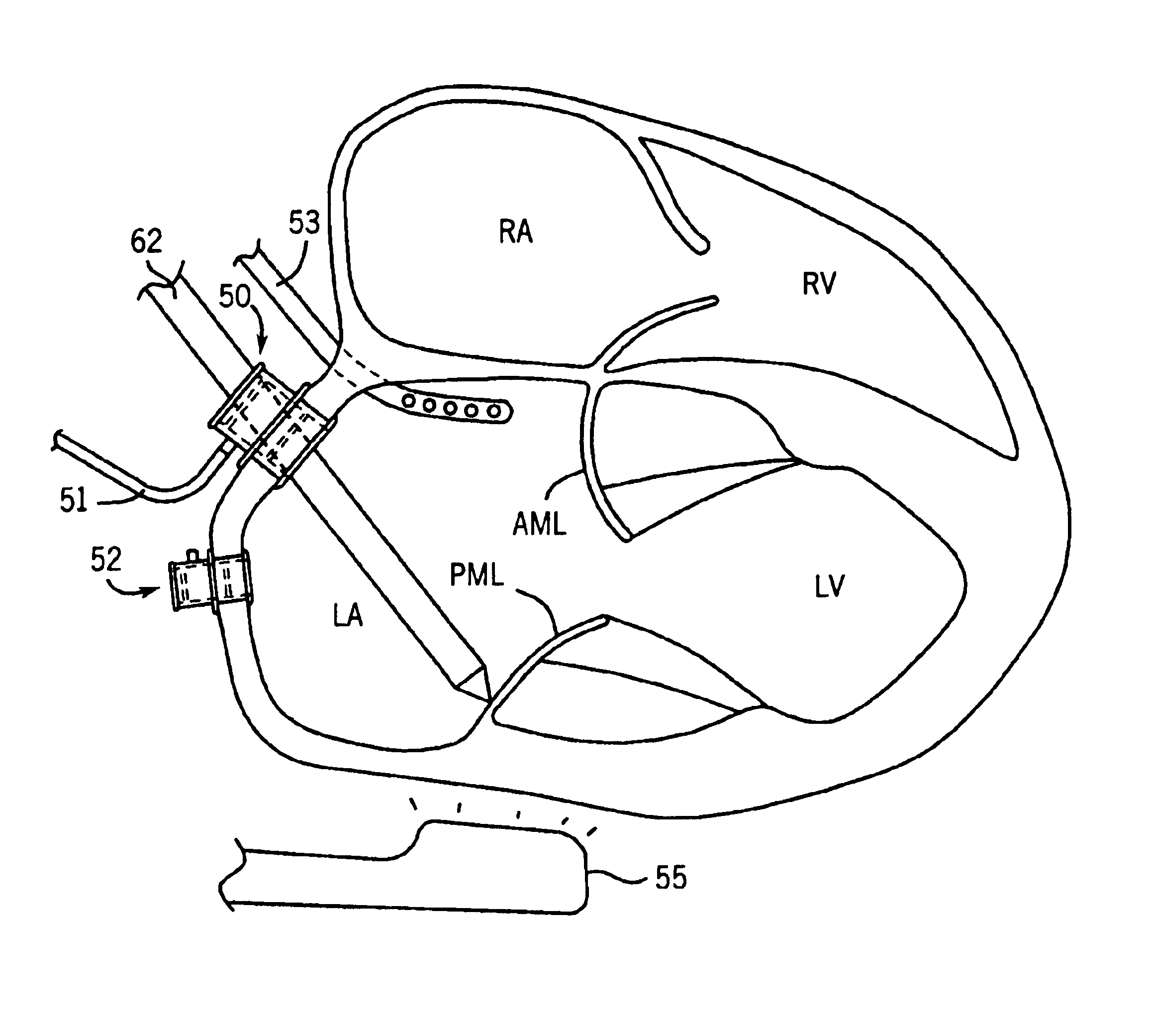 Apparatuses and methods for performing minimally invasive diagnostic and surgical procedures inside of a beating heart