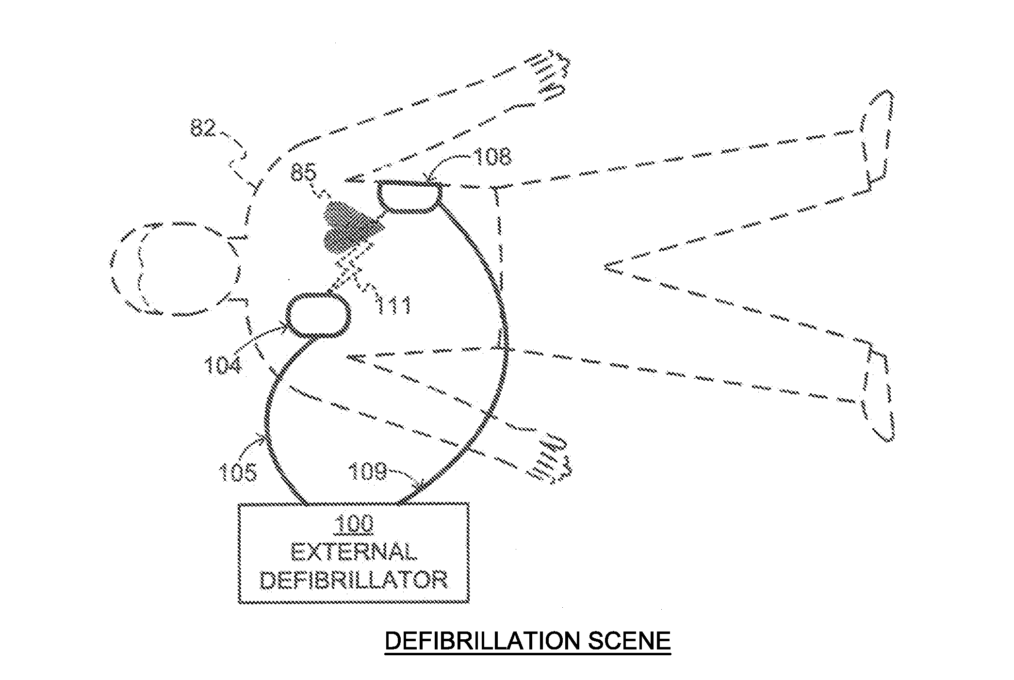 External Defibrillator Electrode, Method and System for Reducing ECG Artifact