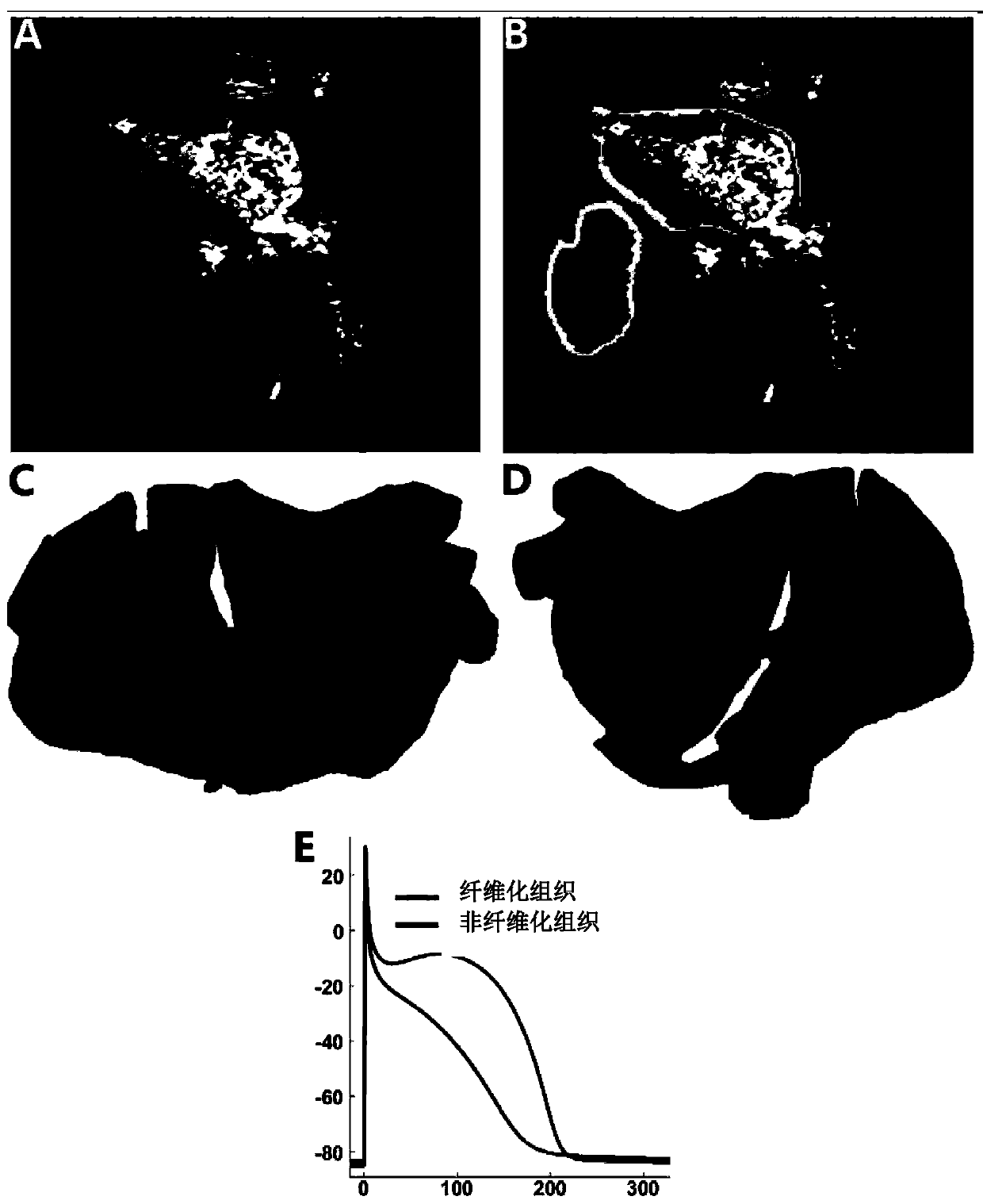 Ablation device and system for treating atrial fibrillation