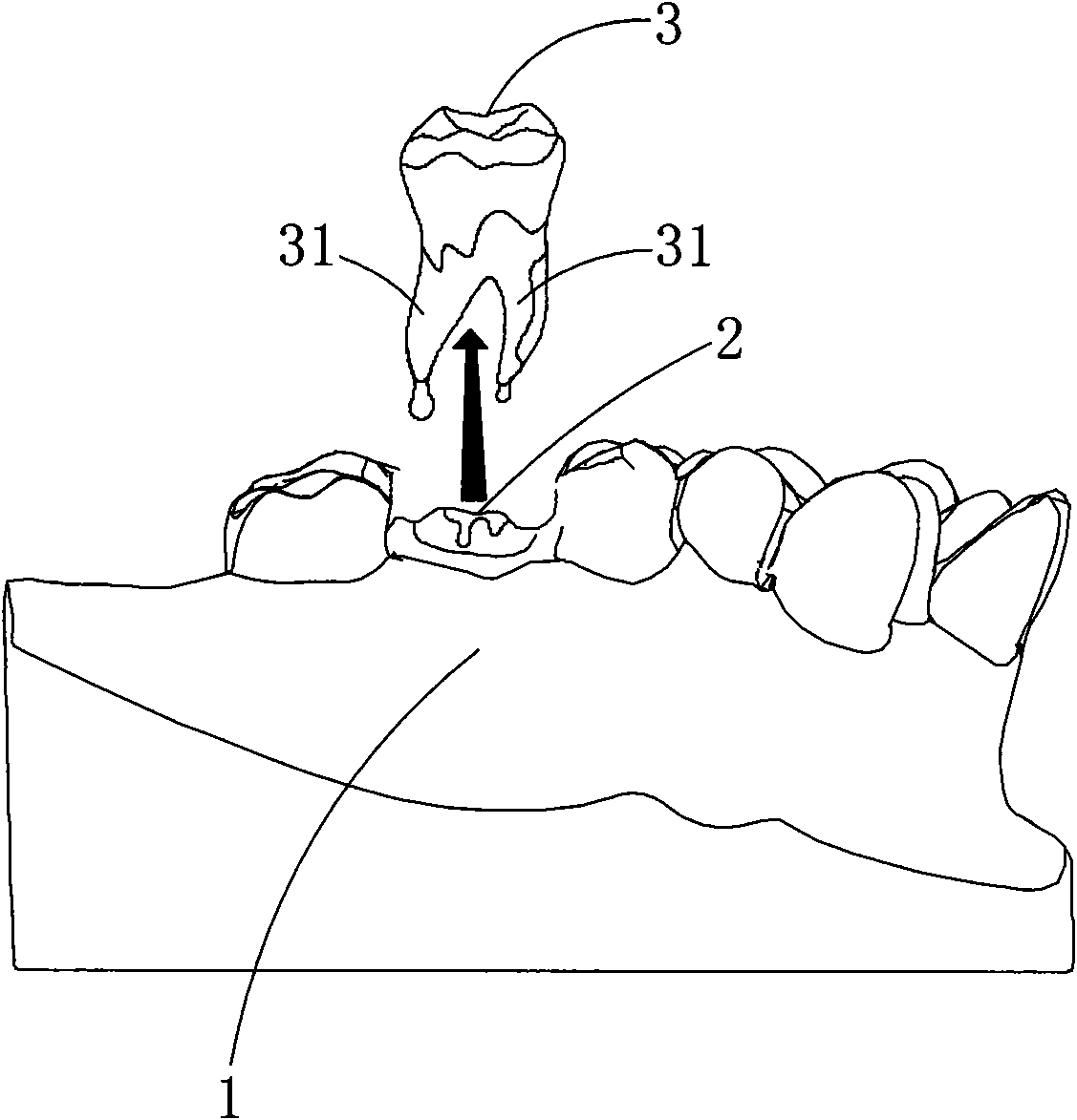 Tooth extracting model