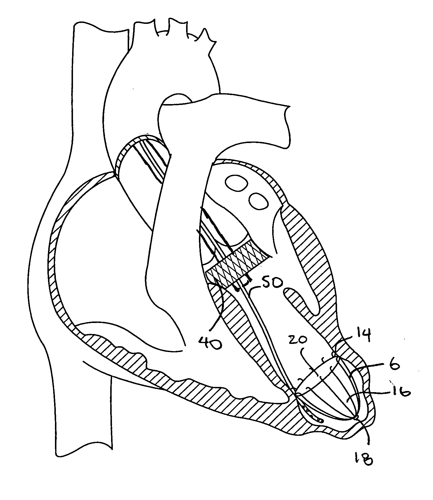 Methods and devices for altering blood flow through the left ventricle