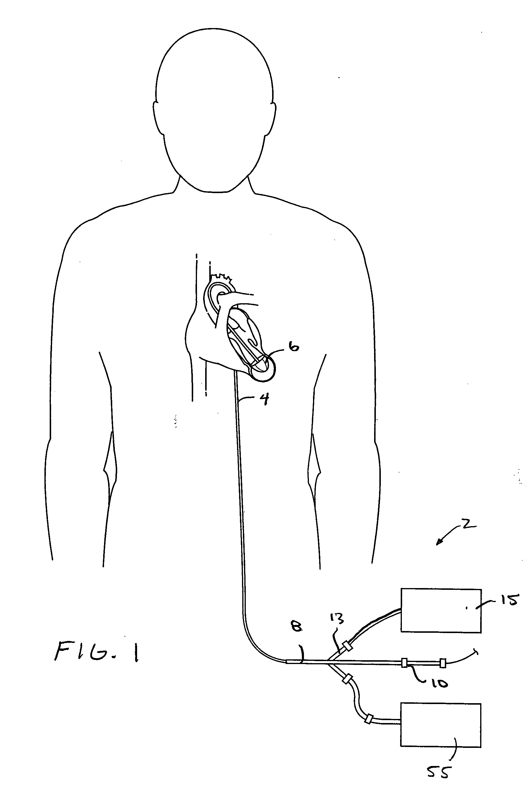 Methods and devices for altering blood flow through the left ventricle