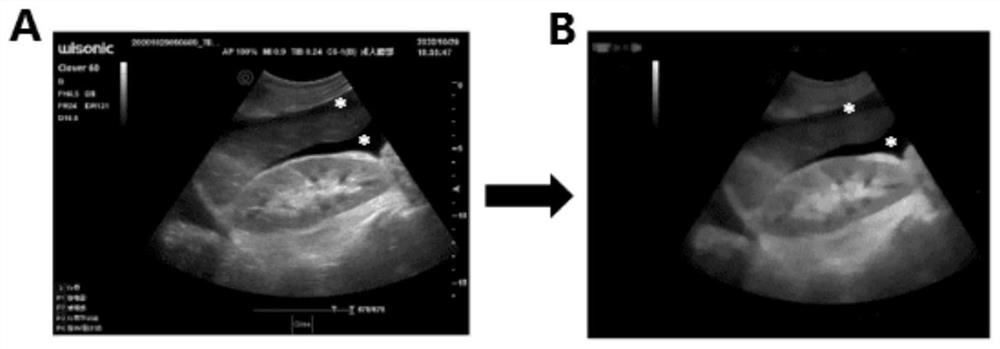 Automatic identification method for seroperitoneum B-mode ultrasound image