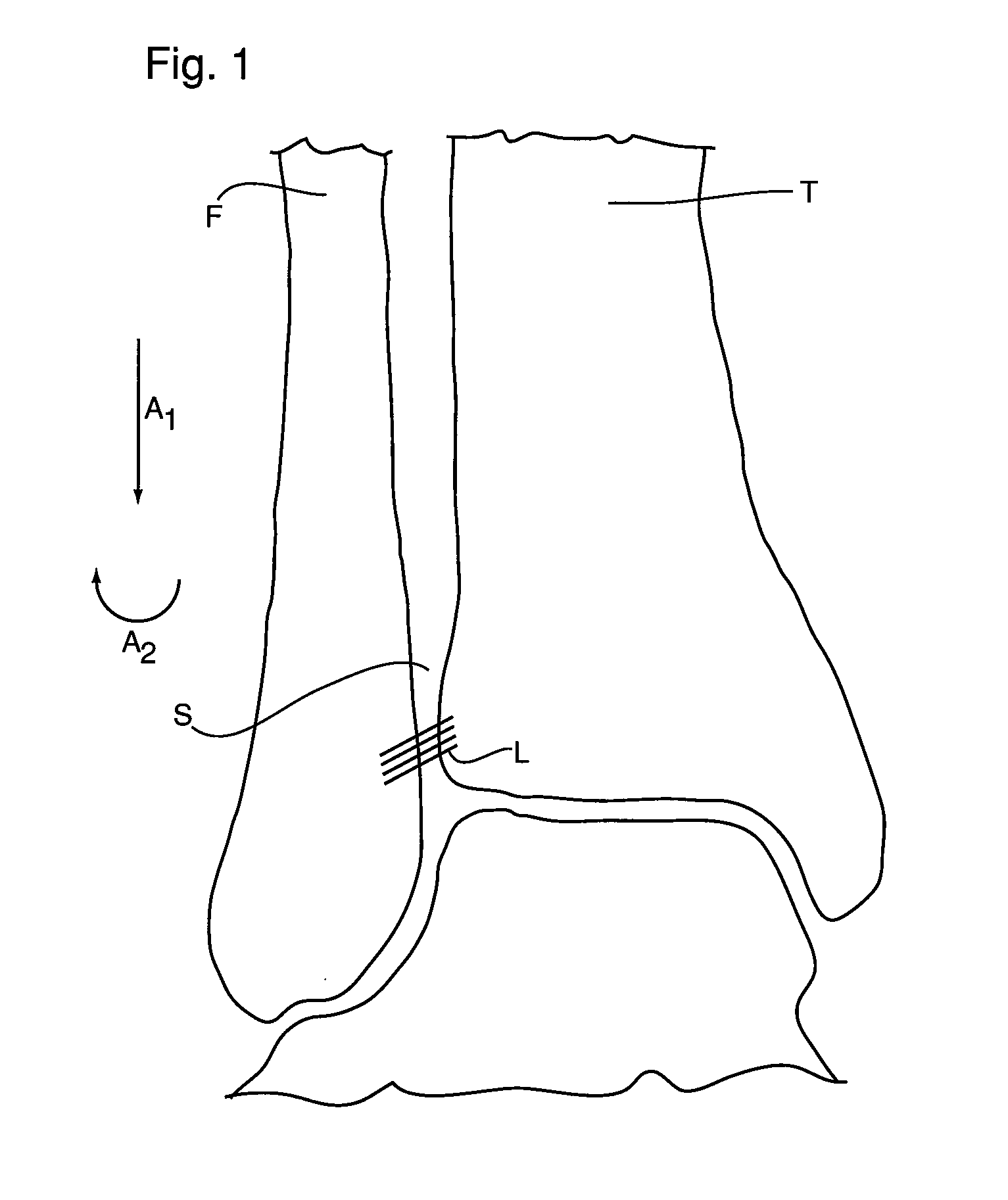 Bone fixation device and method of use thereof