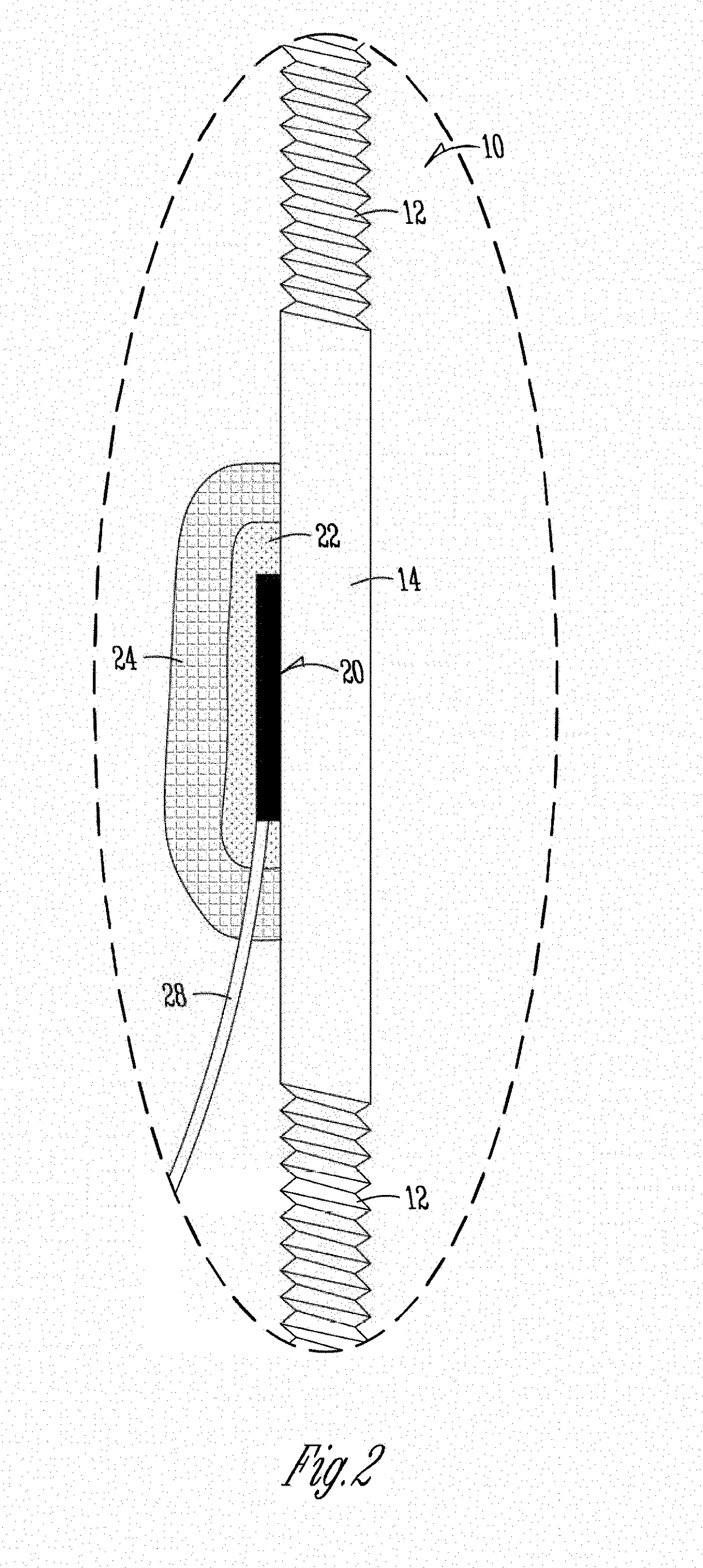 Mobile monitoring of fracture healing in external fixators