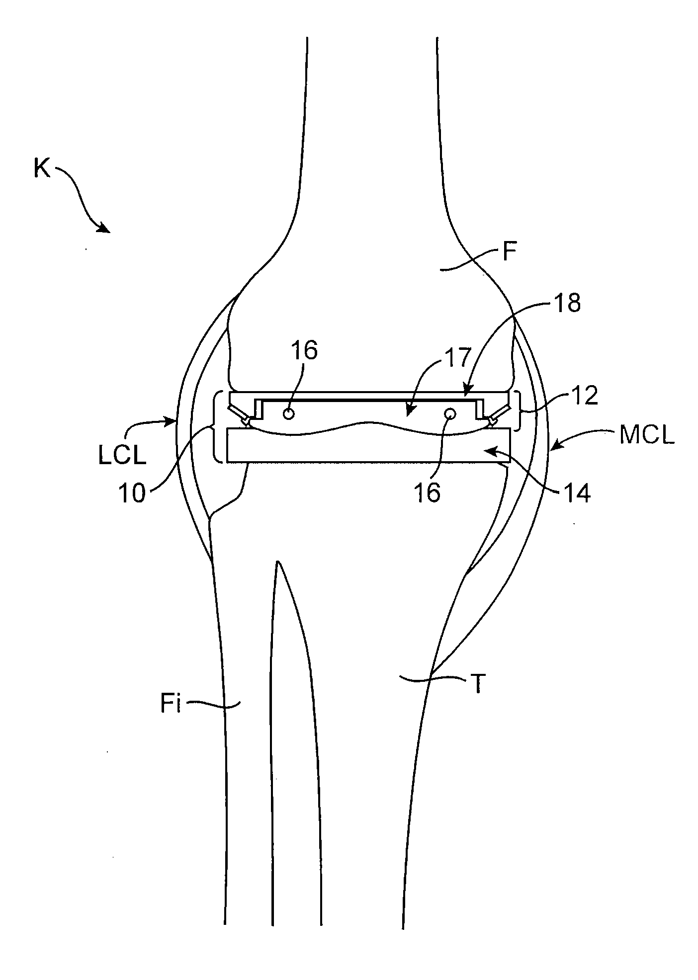 Dynamic knee balancer with pressure sensing