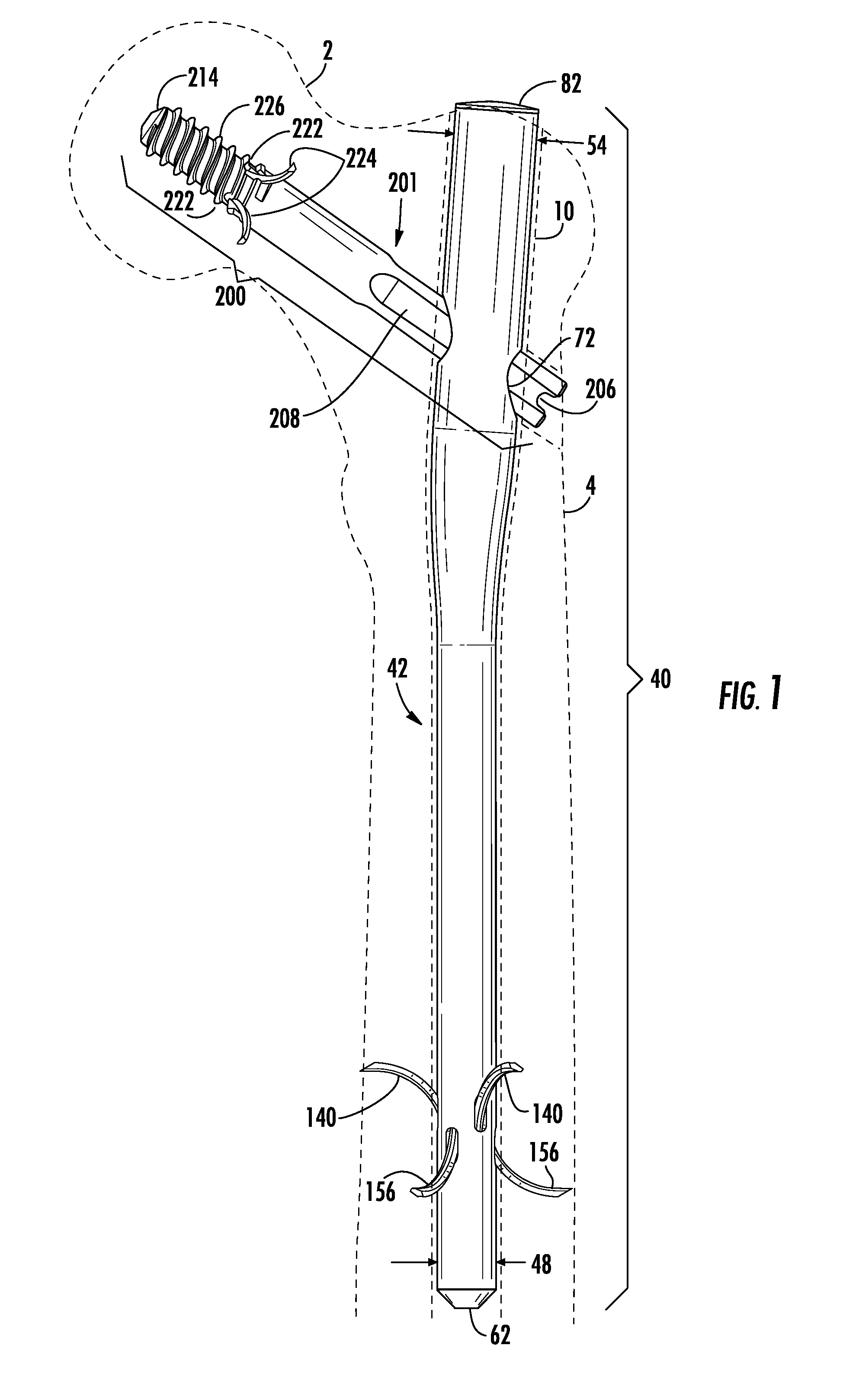 Intramedullary nail system including tang-deployment screw with male interface