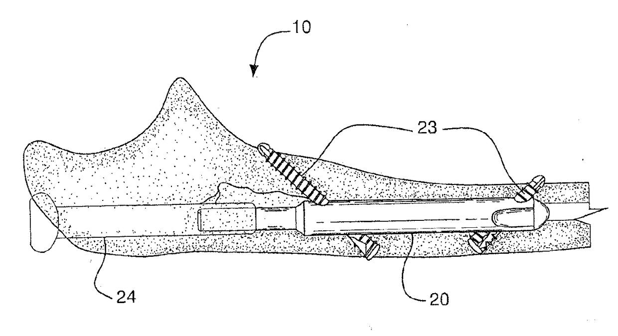 Nail System and Method for an Olecranon Osteotomy