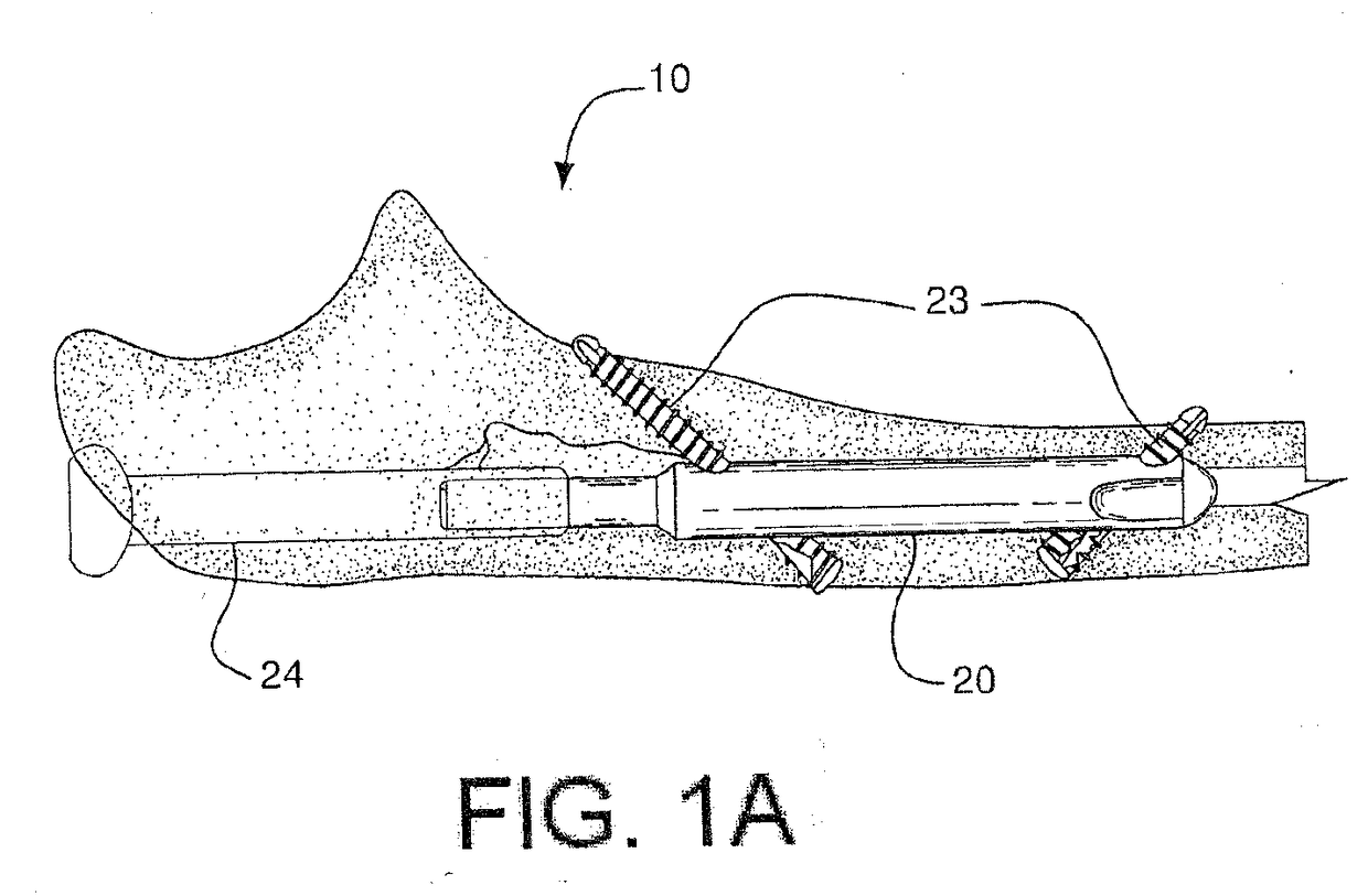 Nail System and Method for an Olecranon Osteotomy