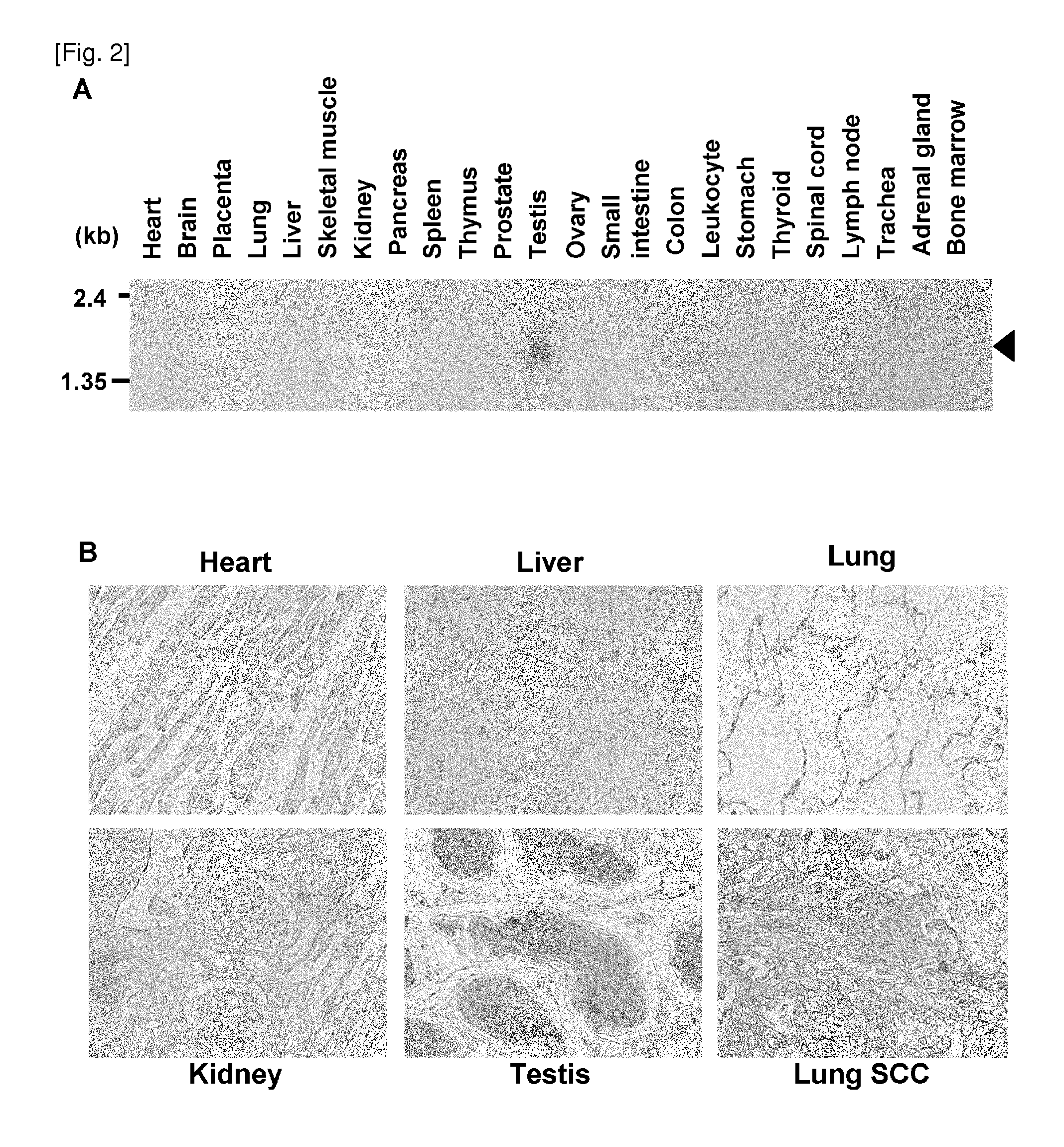 Cancer associated gene ly6k