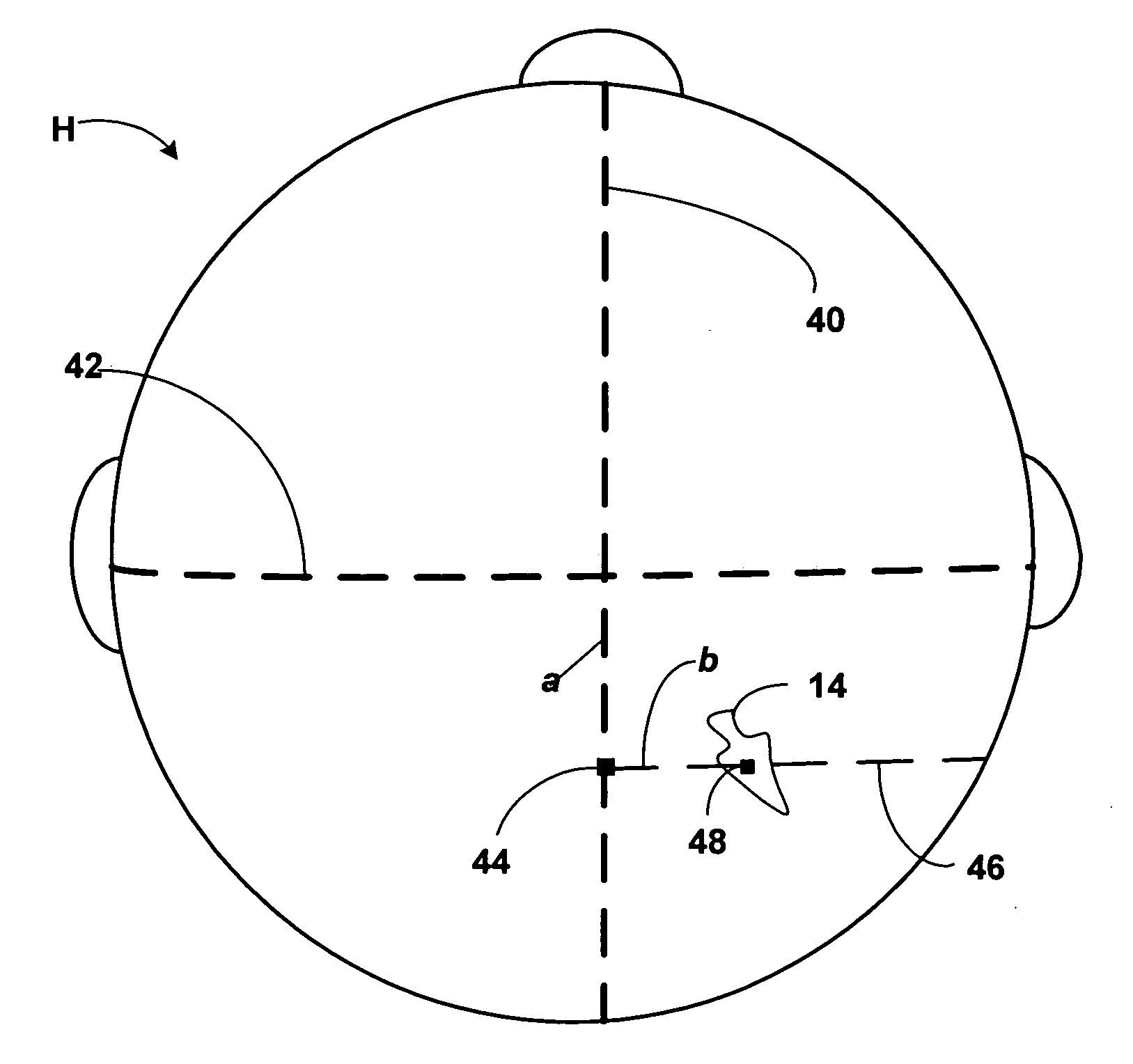 Method for locating brain lesion