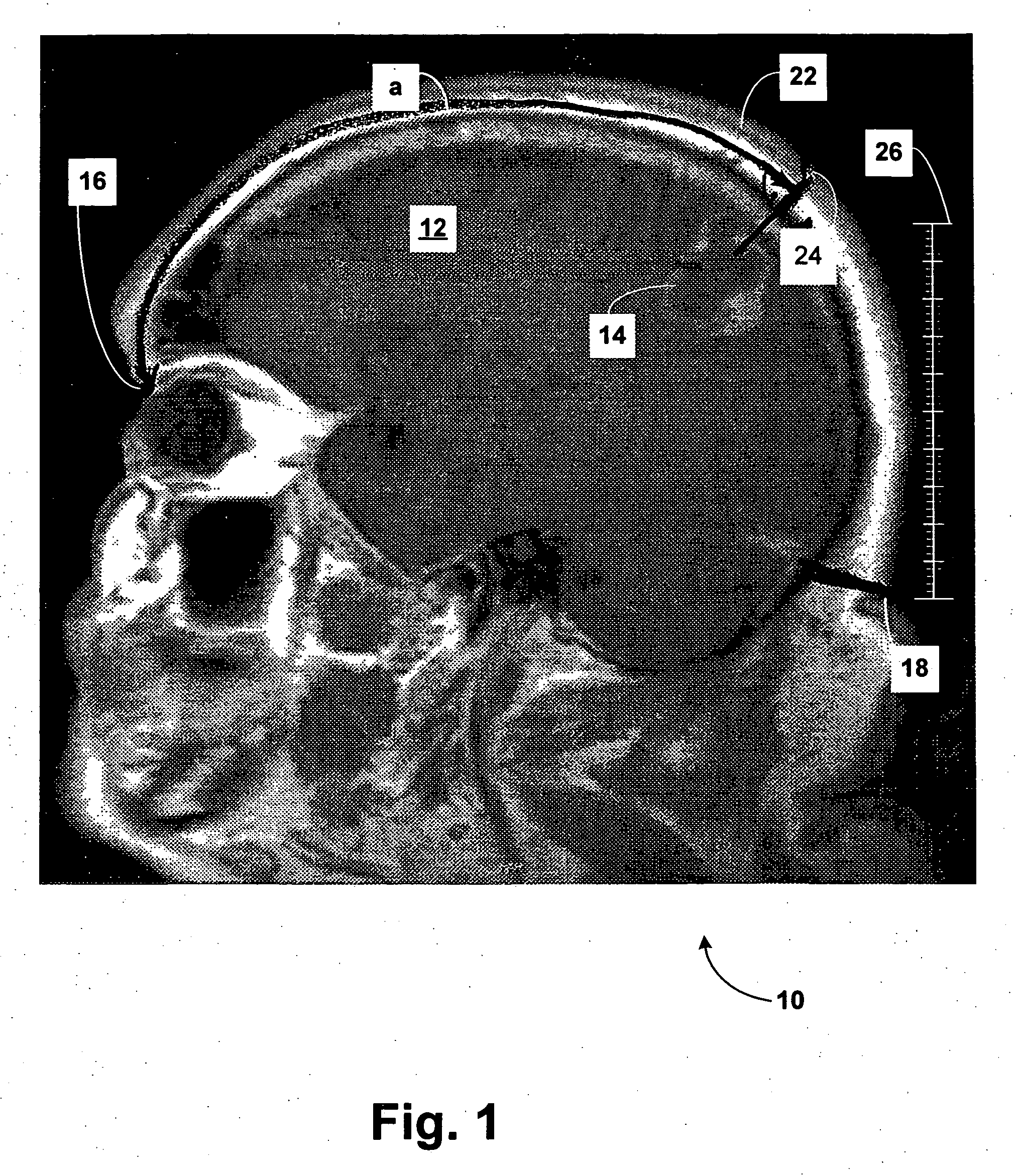 Method for locating brain lesion