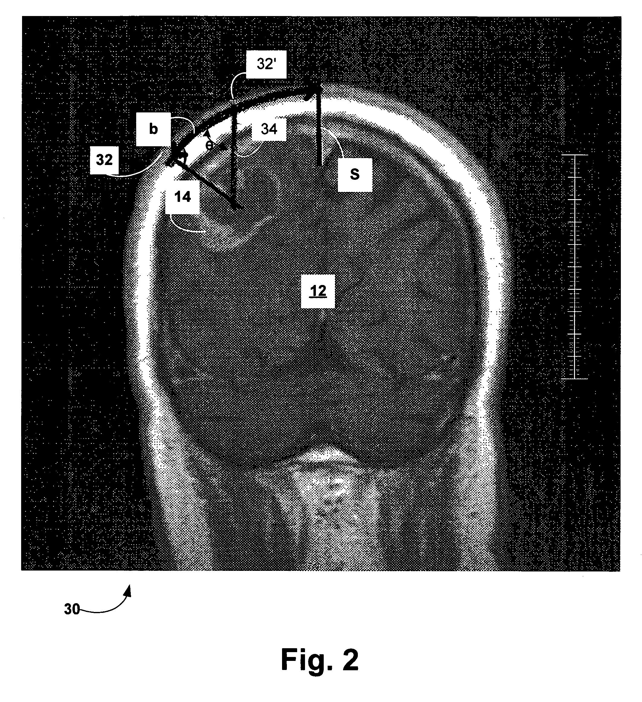 Method for locating brain lesion