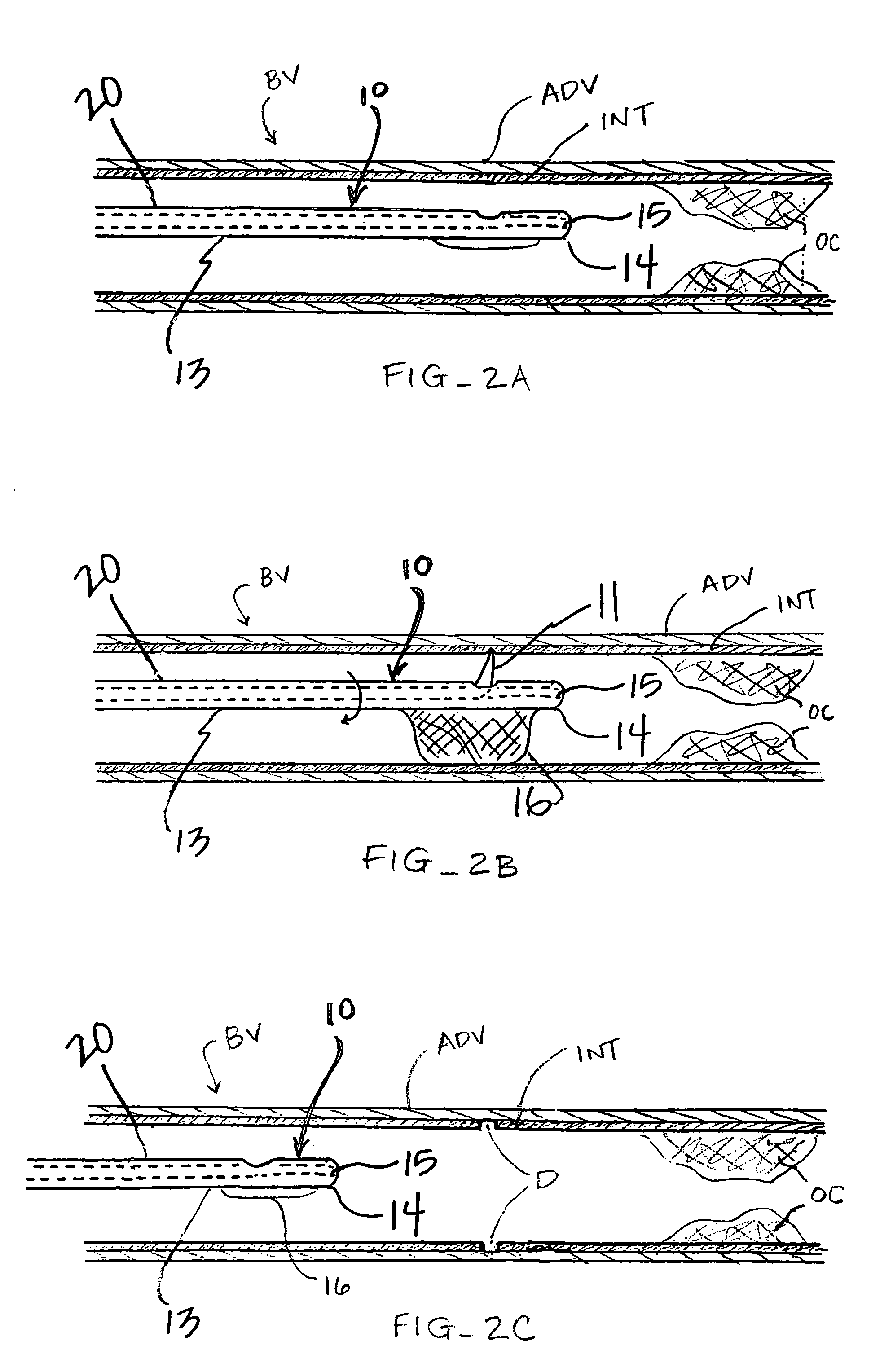 Devices for percutaneous remote endarterectomy