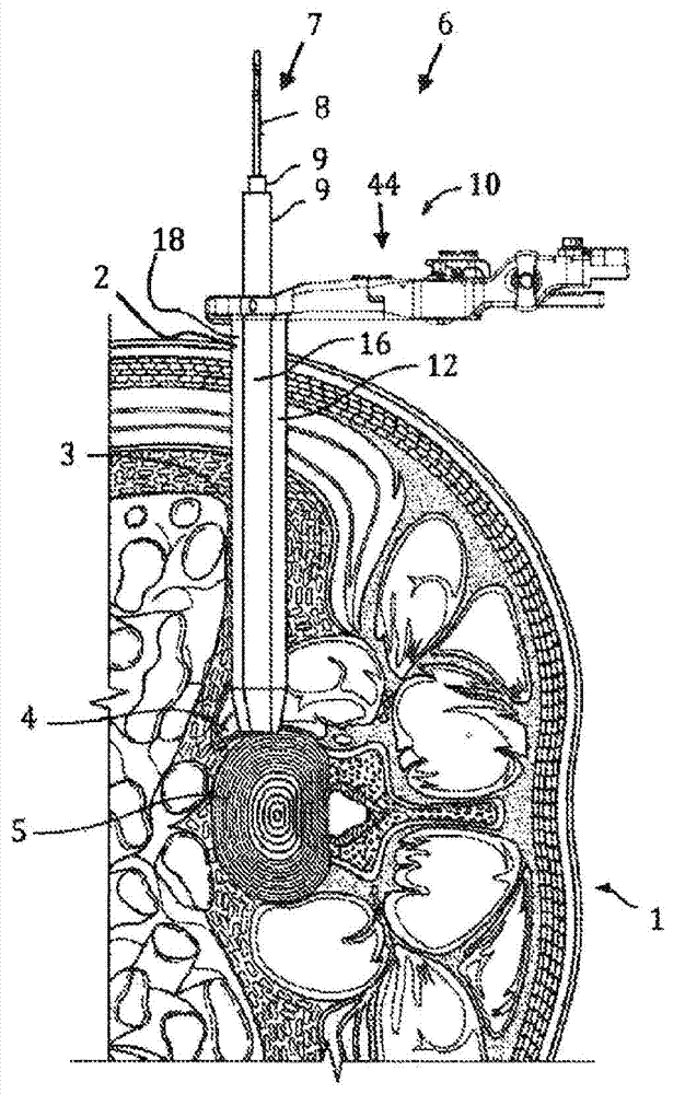 Surgical access system and related methods