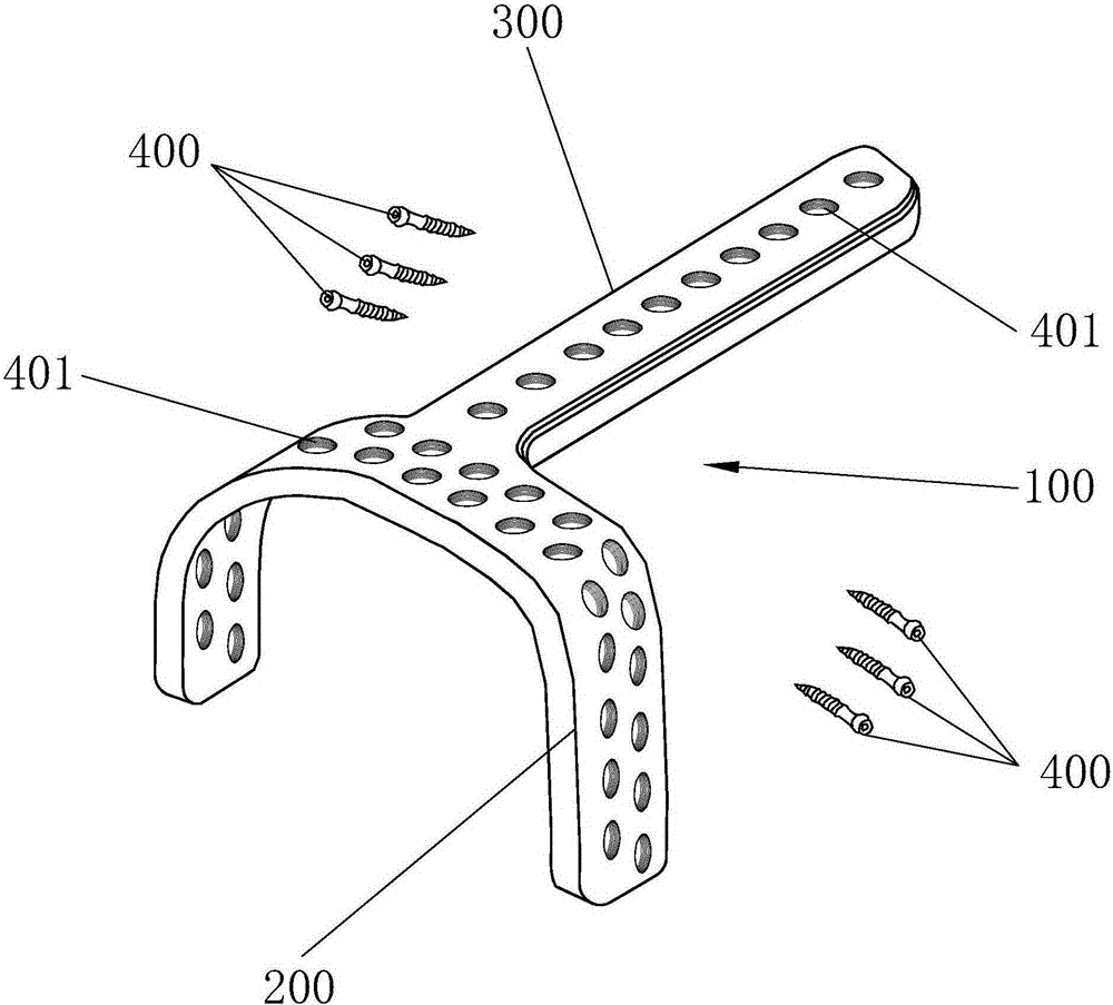 Fixing system for treating fracture of tibial plateau