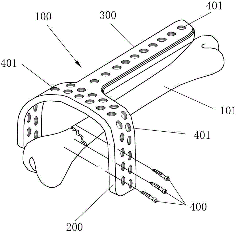 Fixing system for treating fracture of tibial plateau