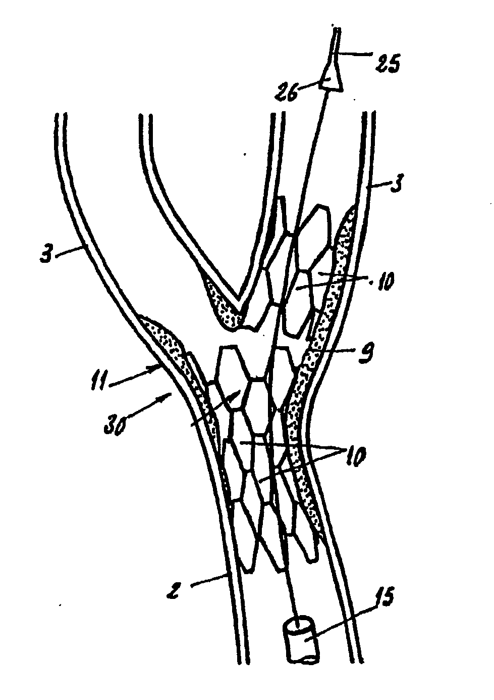 Endoprosthesis for vascular bifurcation