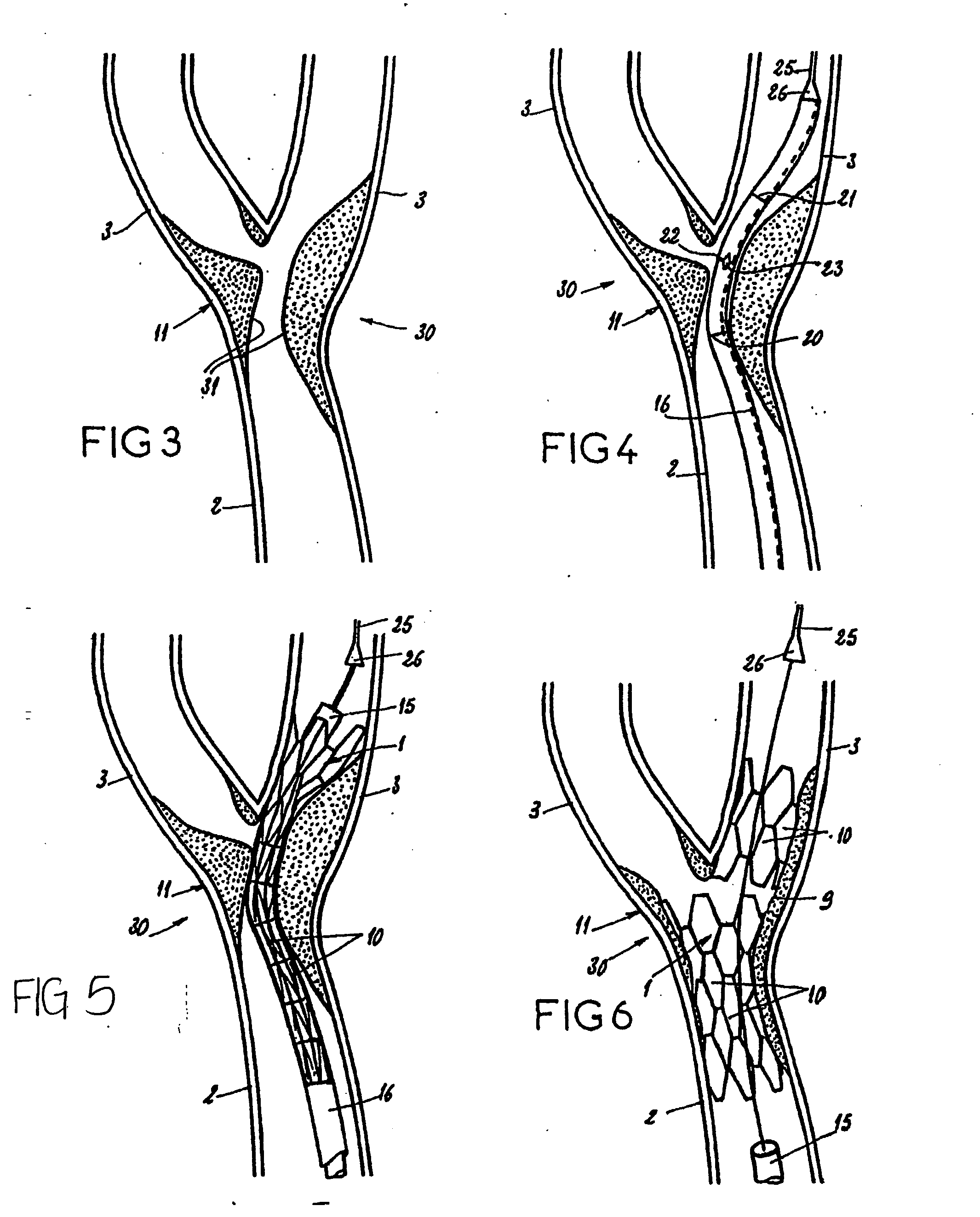 Endoprosthesis for vascular bifurcation