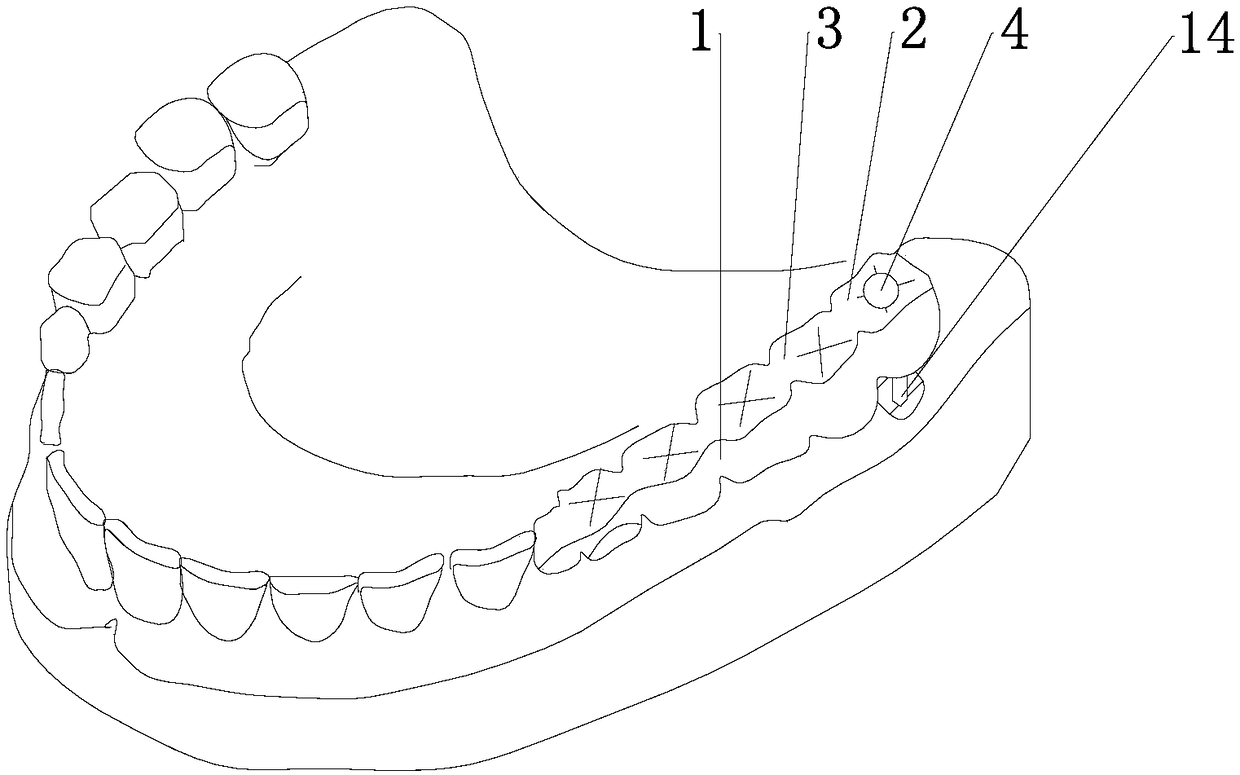 Convenient-to-mount dental prosthesis