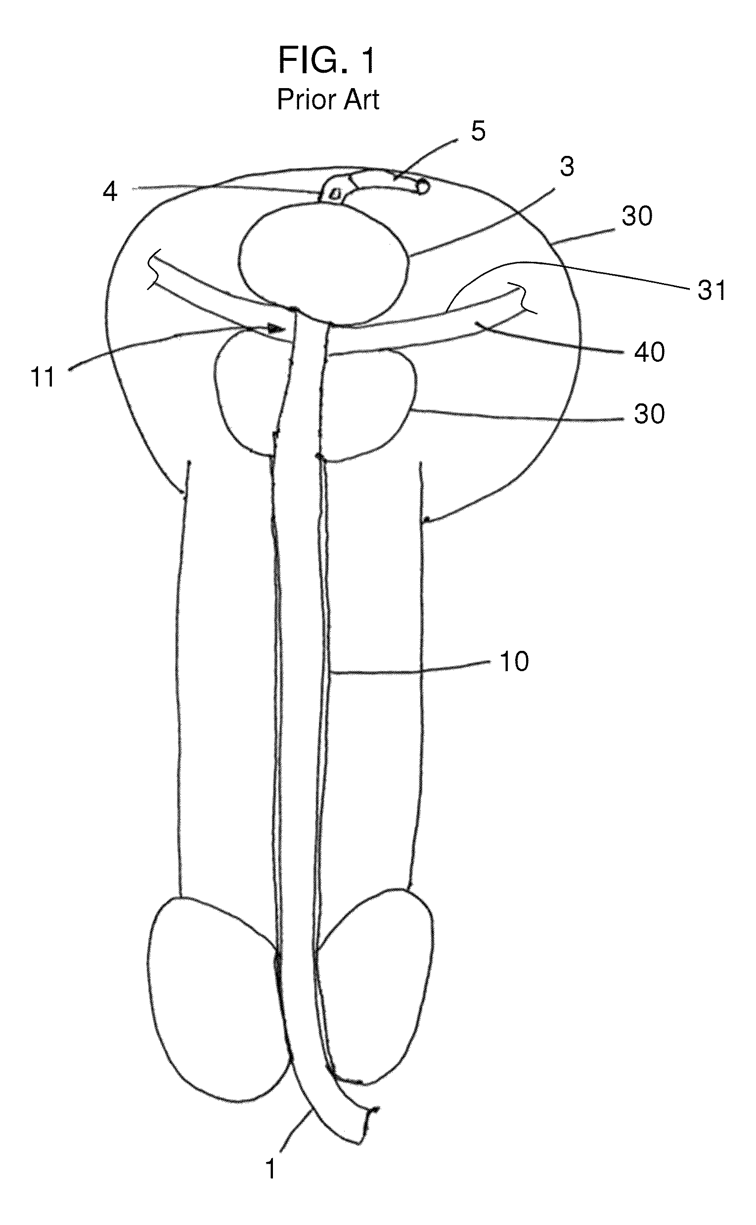 Stretch valve balloon catheter and methods for producing and using same