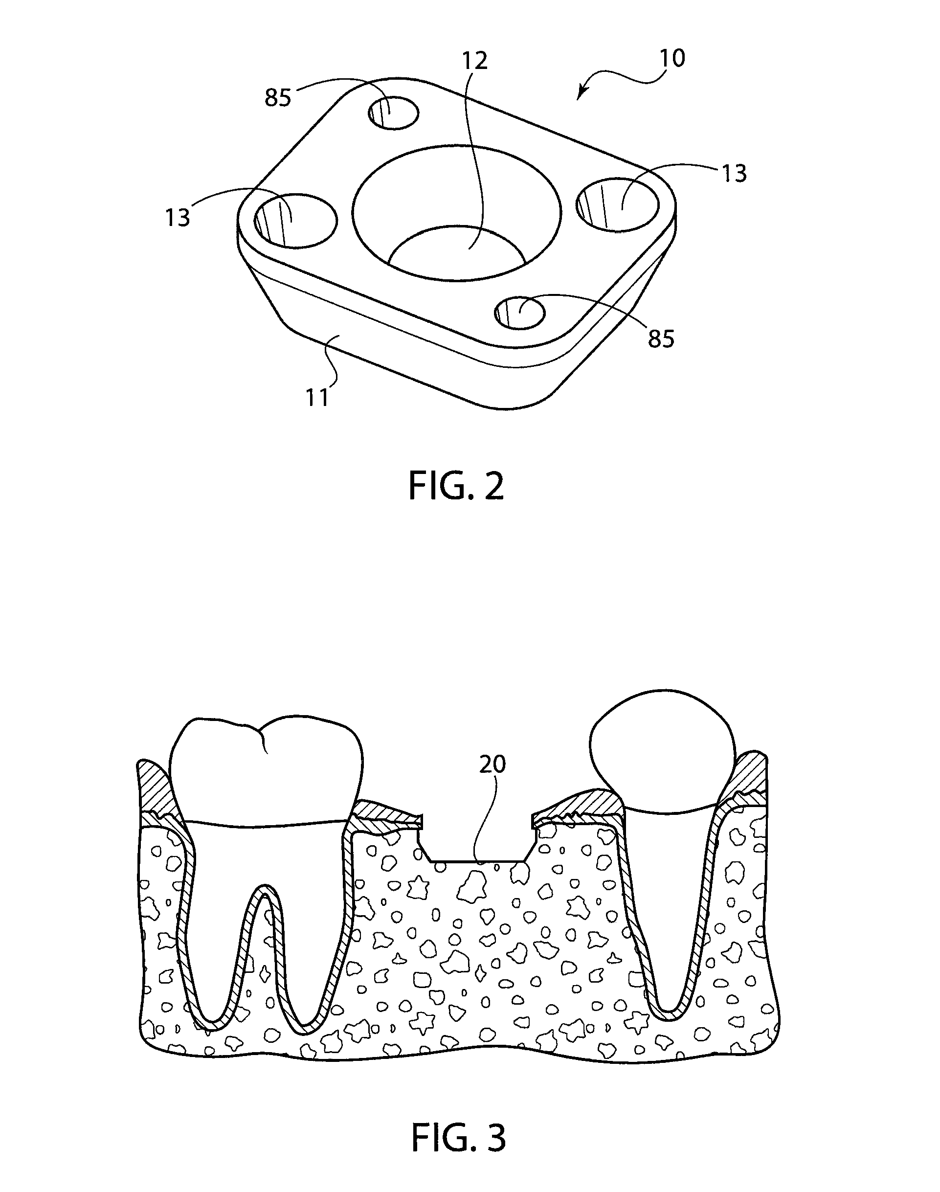 Dental implant instrumentation and methods