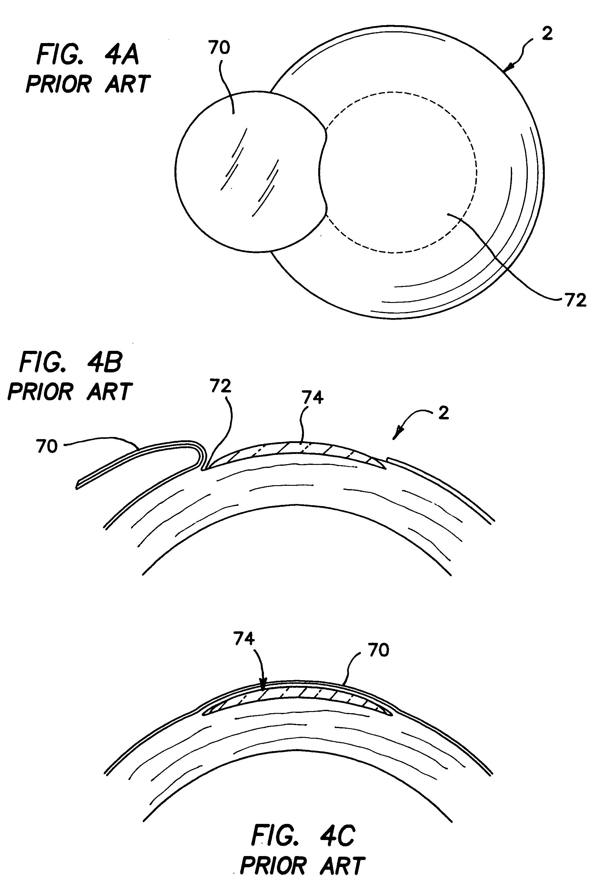 Intrastromal devices and methods for improving vision