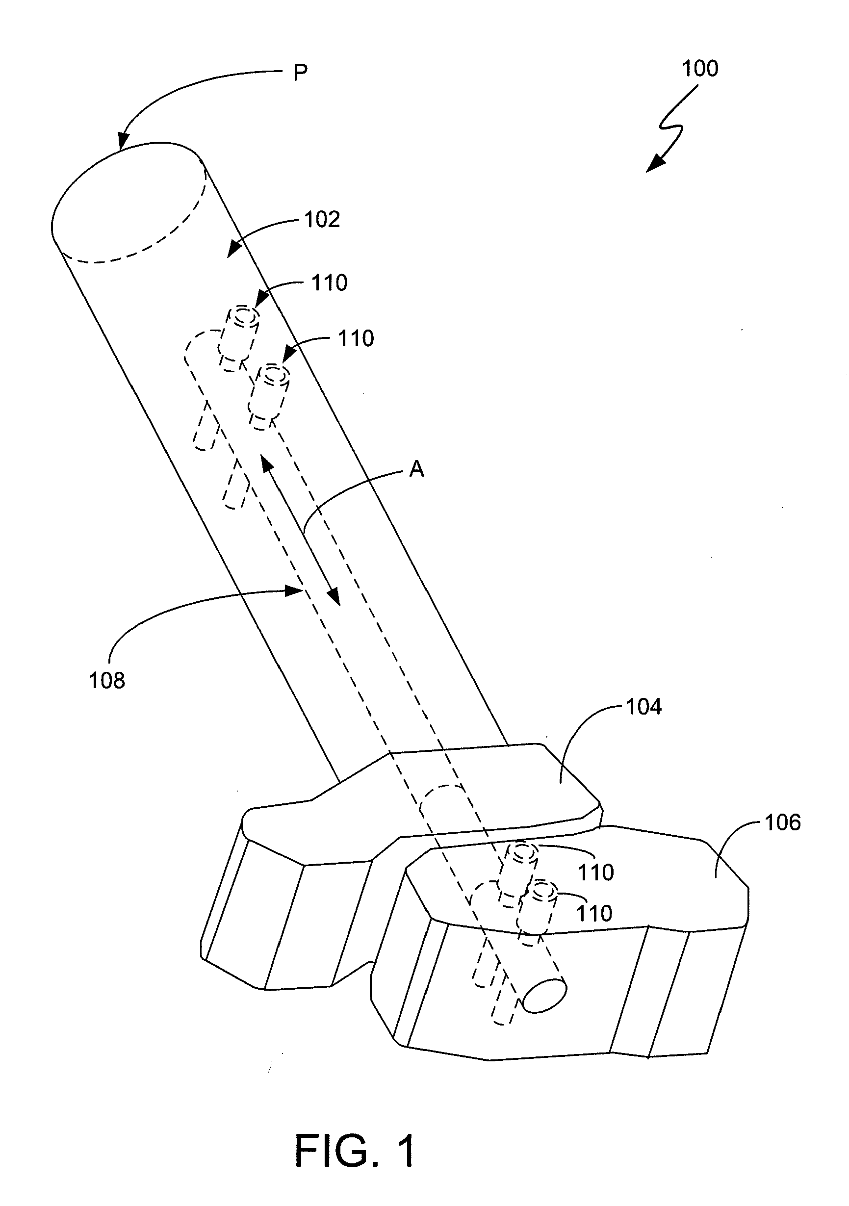 Intramedullary medical device and methods of use and manufacture