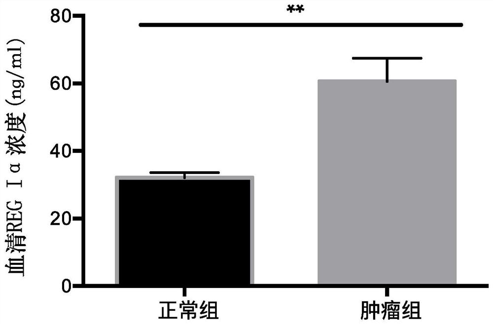 Application of human serum REG I alpha serving as detection target or standard substance in preparation of reagent or kit for predicting tumors