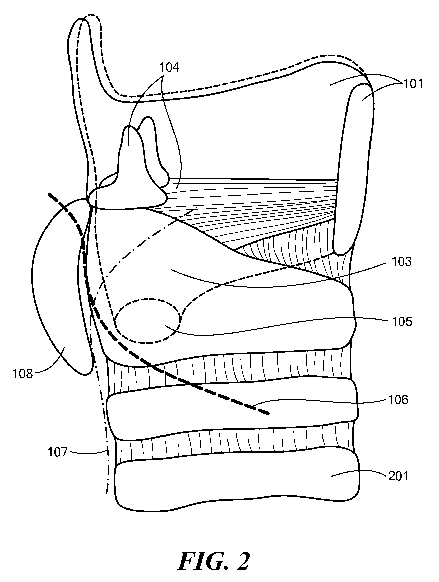 System, Apparatus, and Method for Facilitating Interface with Laryngeal Structures