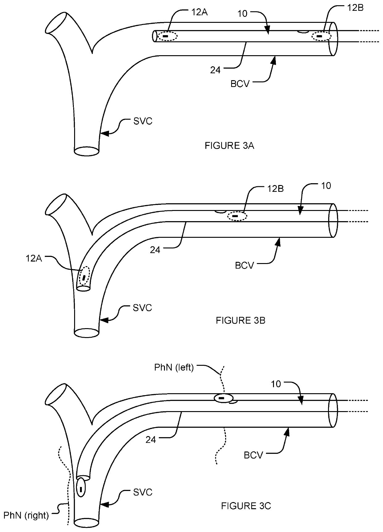 Transvascular nerve stimulation apparatus and methods