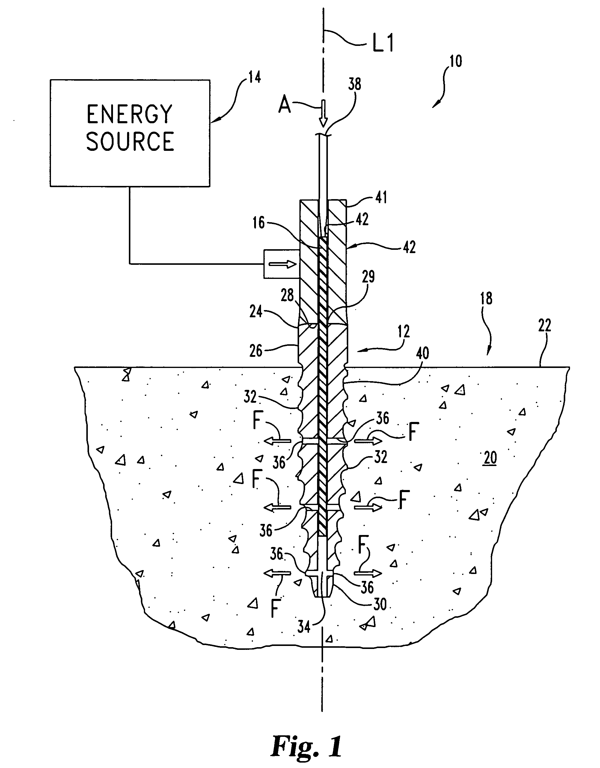 Reinforcement of boney material surrounding a bone implant