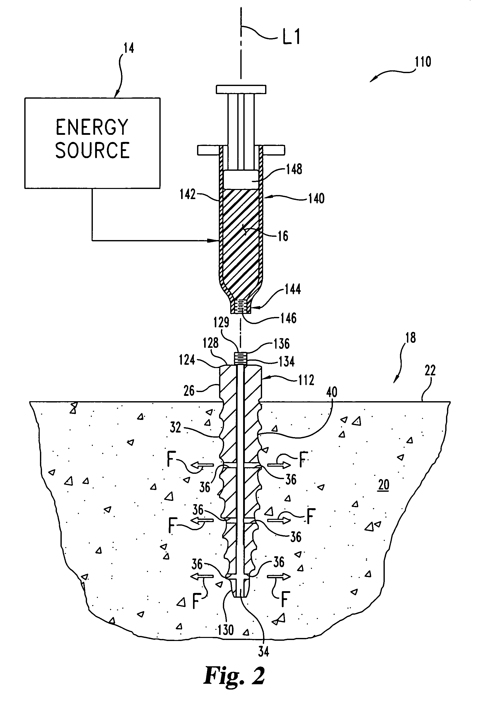 Reinforcement of boney material surrounding a bone implant