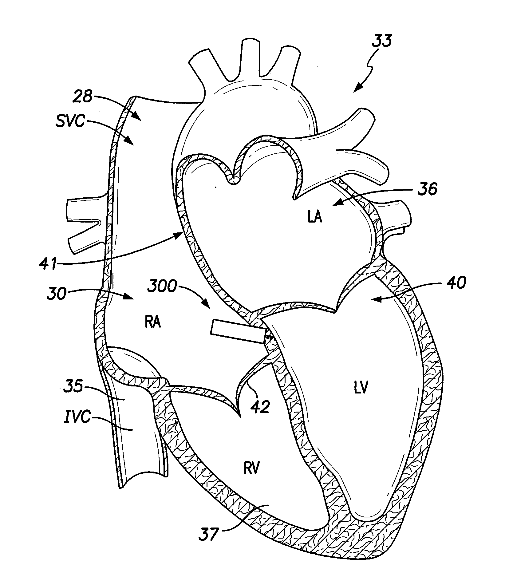 Leadless implantable medical device with dual chamber sensing functionality