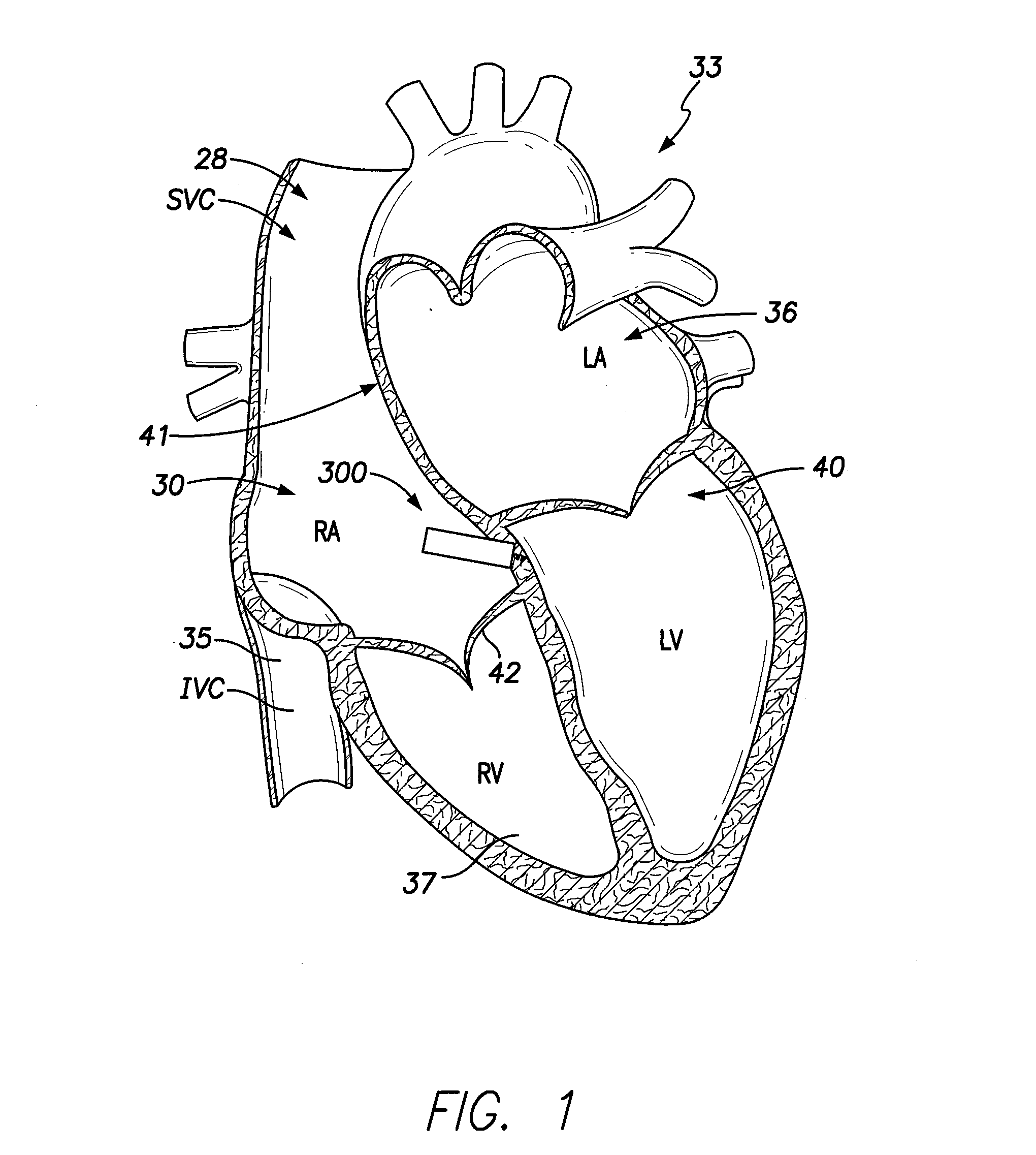 Leadless implantable medical device with dual chamber sensing functionality