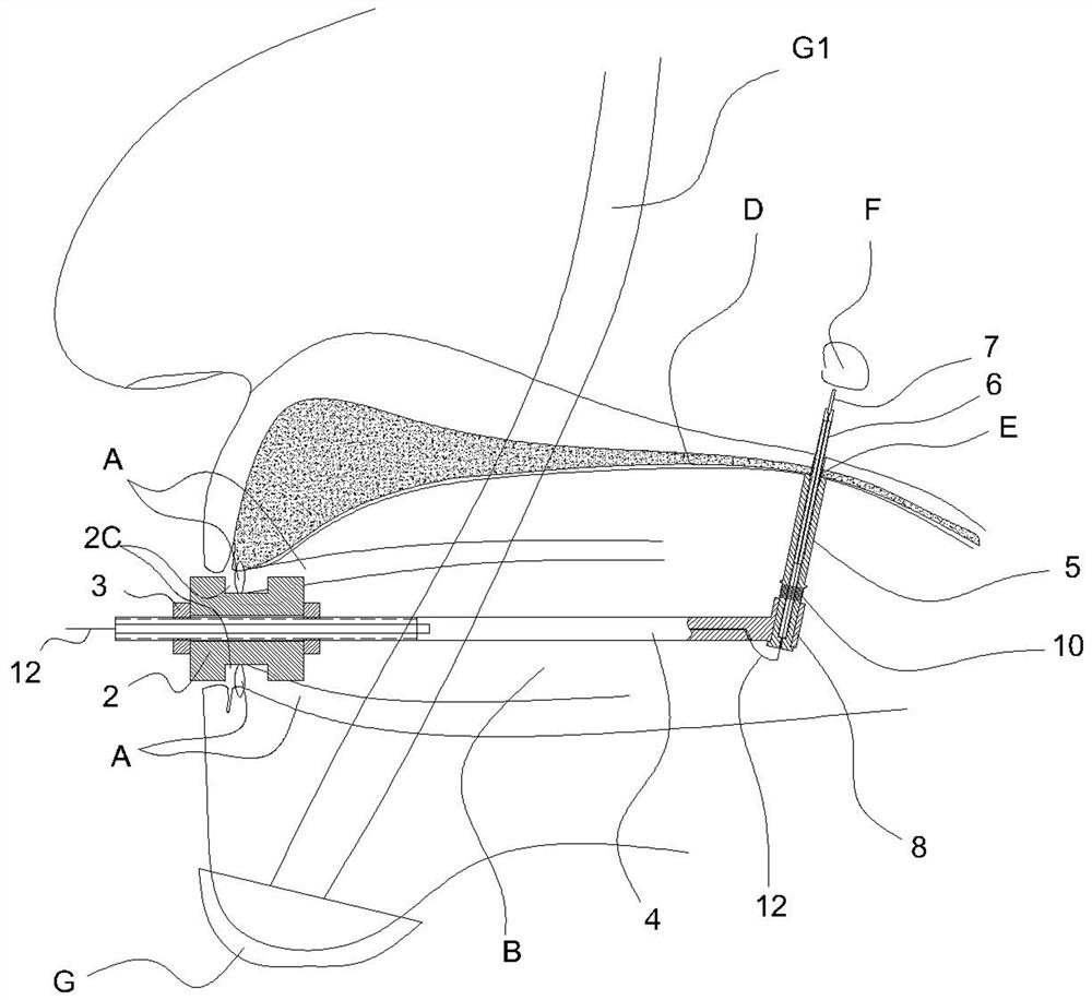 Nerve stimulator