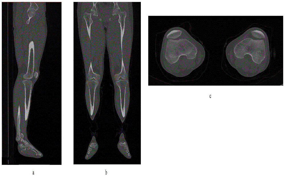 Method for establishing human knee joint three-dimensional simulation model in combination with CT (Computed Tomography) and MRI (Magnetic Resonance Imaging)