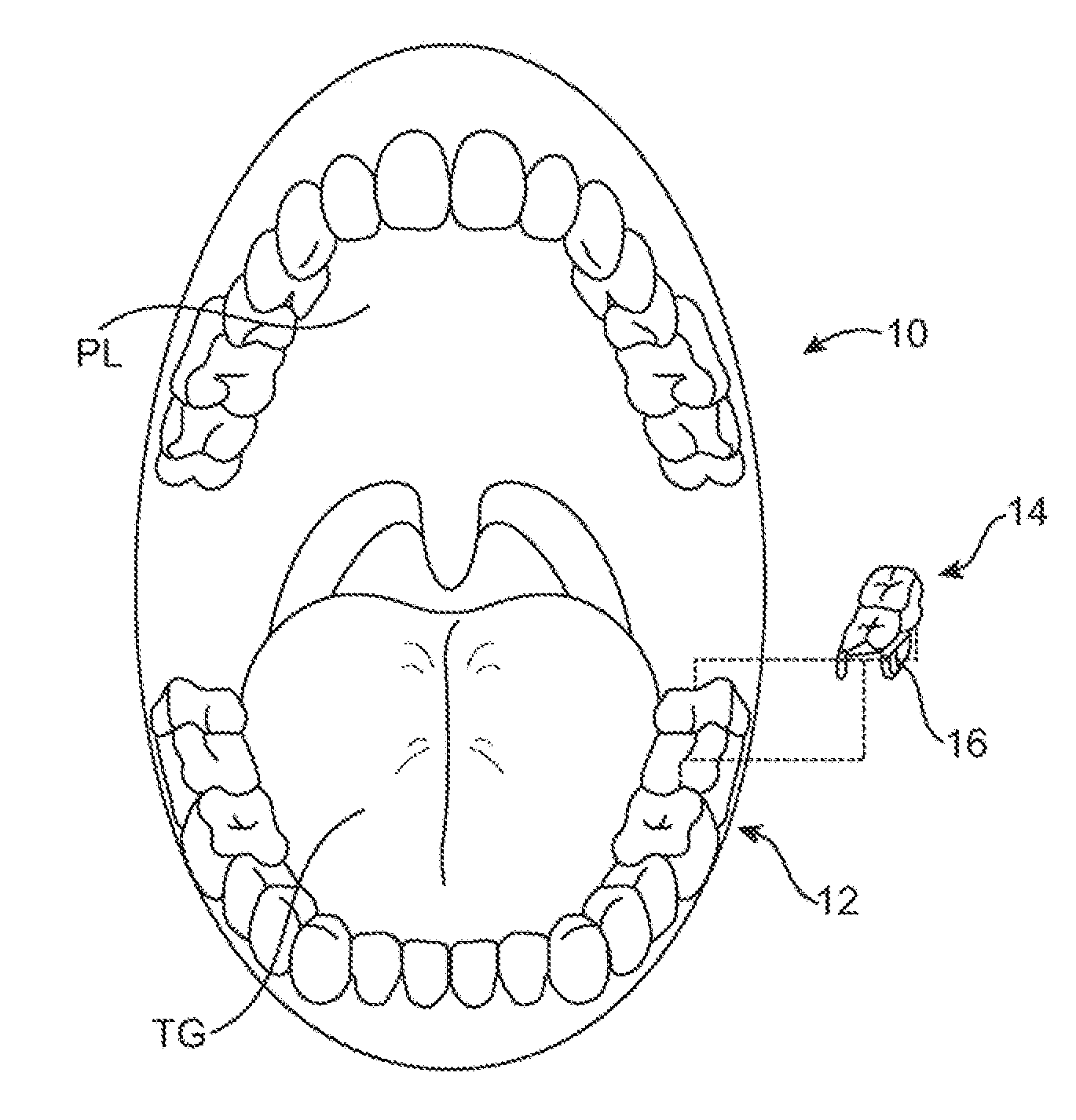 Methods and systems for tinnitus treatment