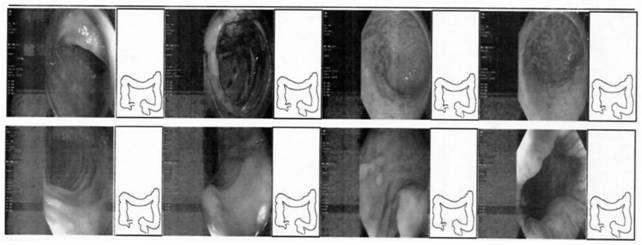 Traditional Chinese medicine composition for treating Crohn's disease and application thereof