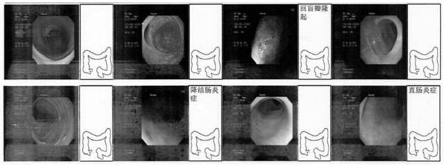 Traditional Chinese medicine composition for treating Crohn's disease and application thereof