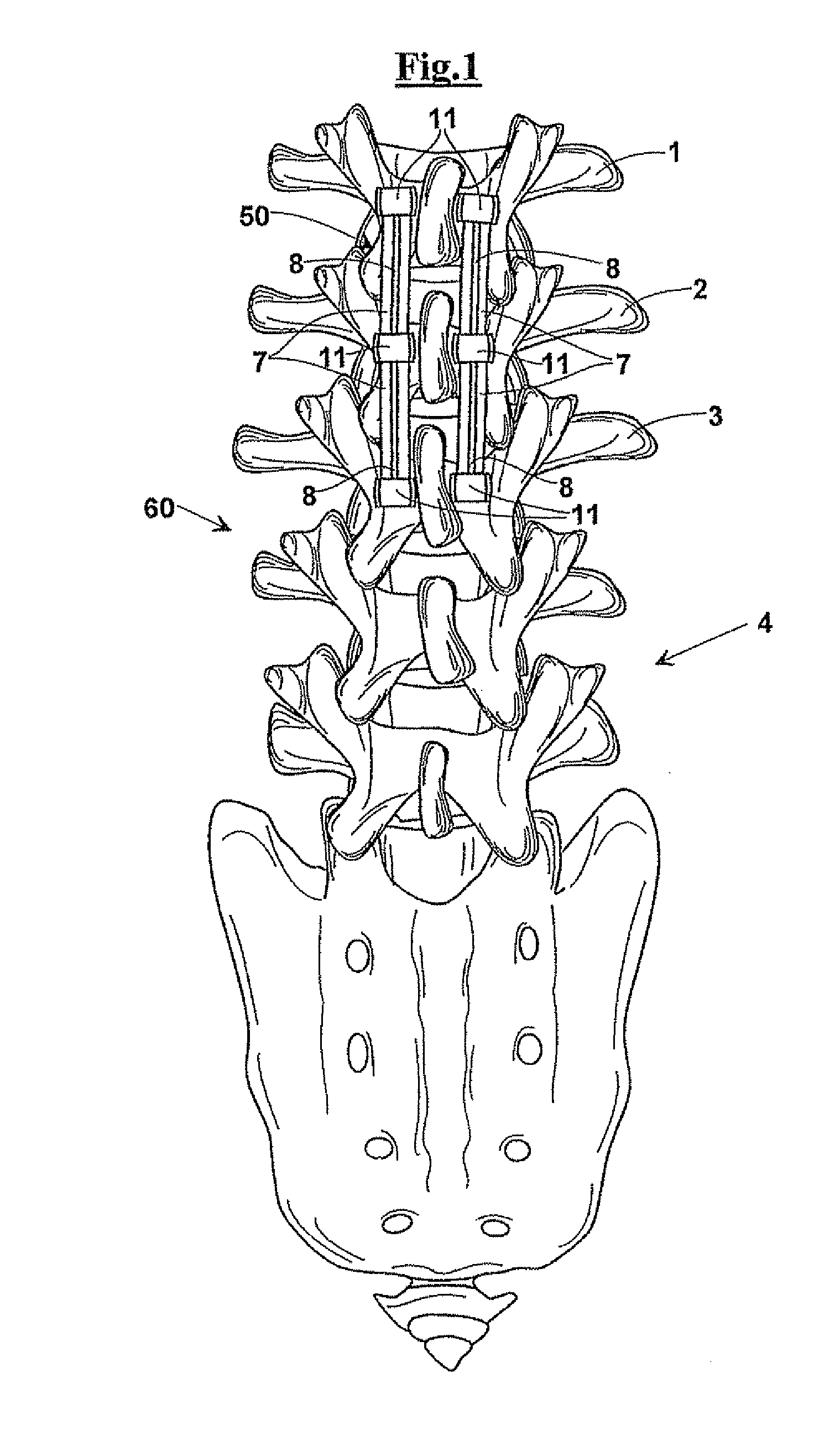 Modular Vertebral Stabilizer