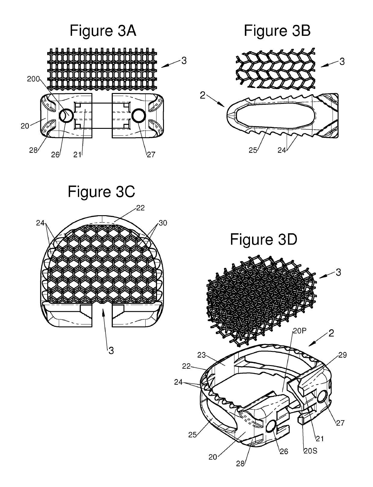 Vertebral system, implant and inserts for vertebral system