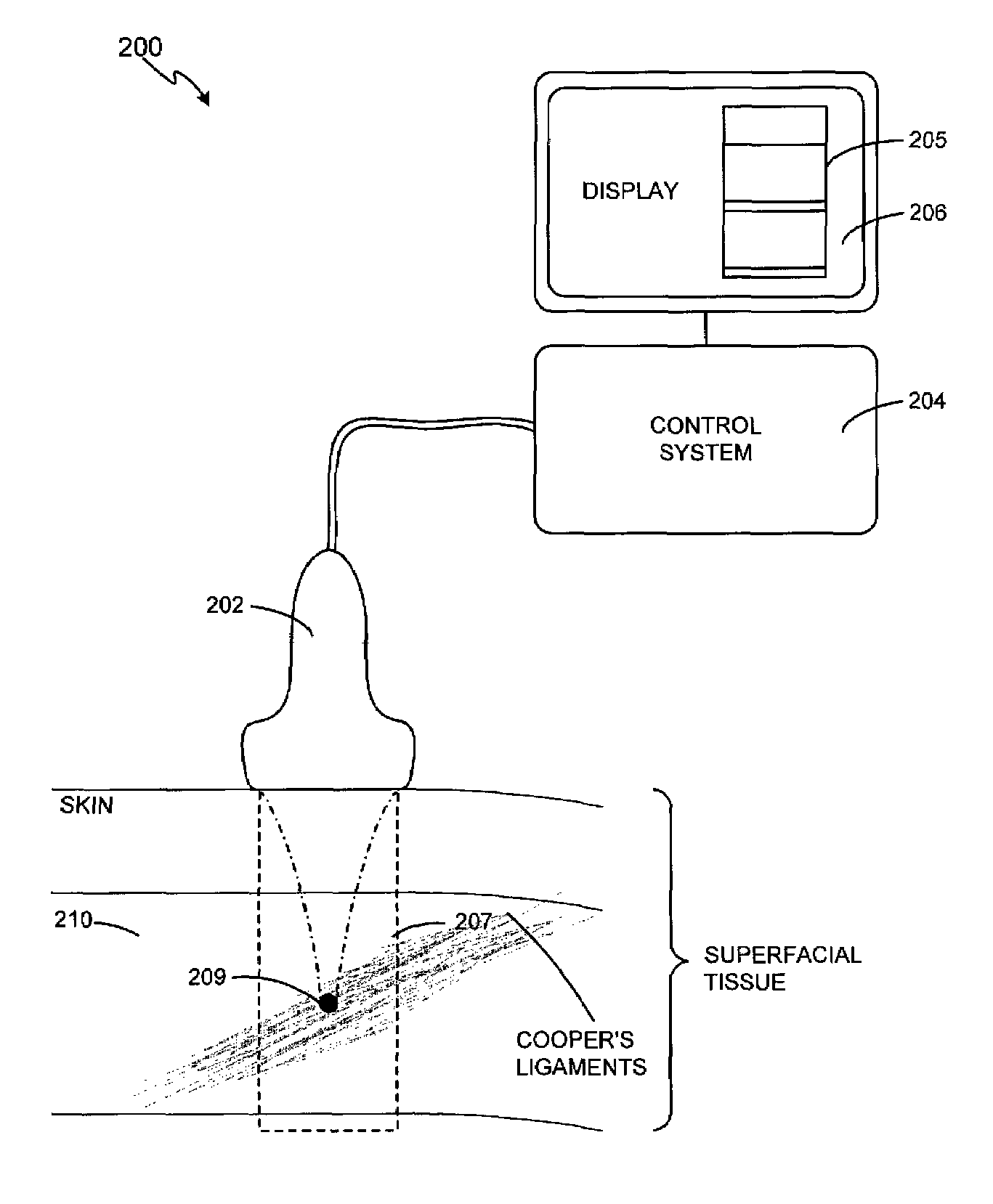 Method and system for noninvasive mastopexy