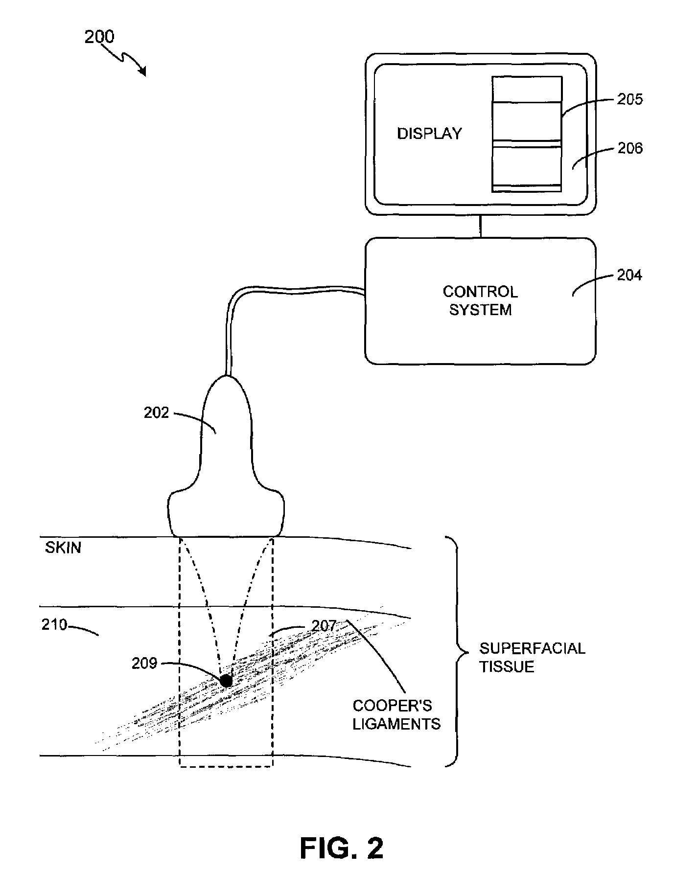 Method and system for noninvasive mastopexy