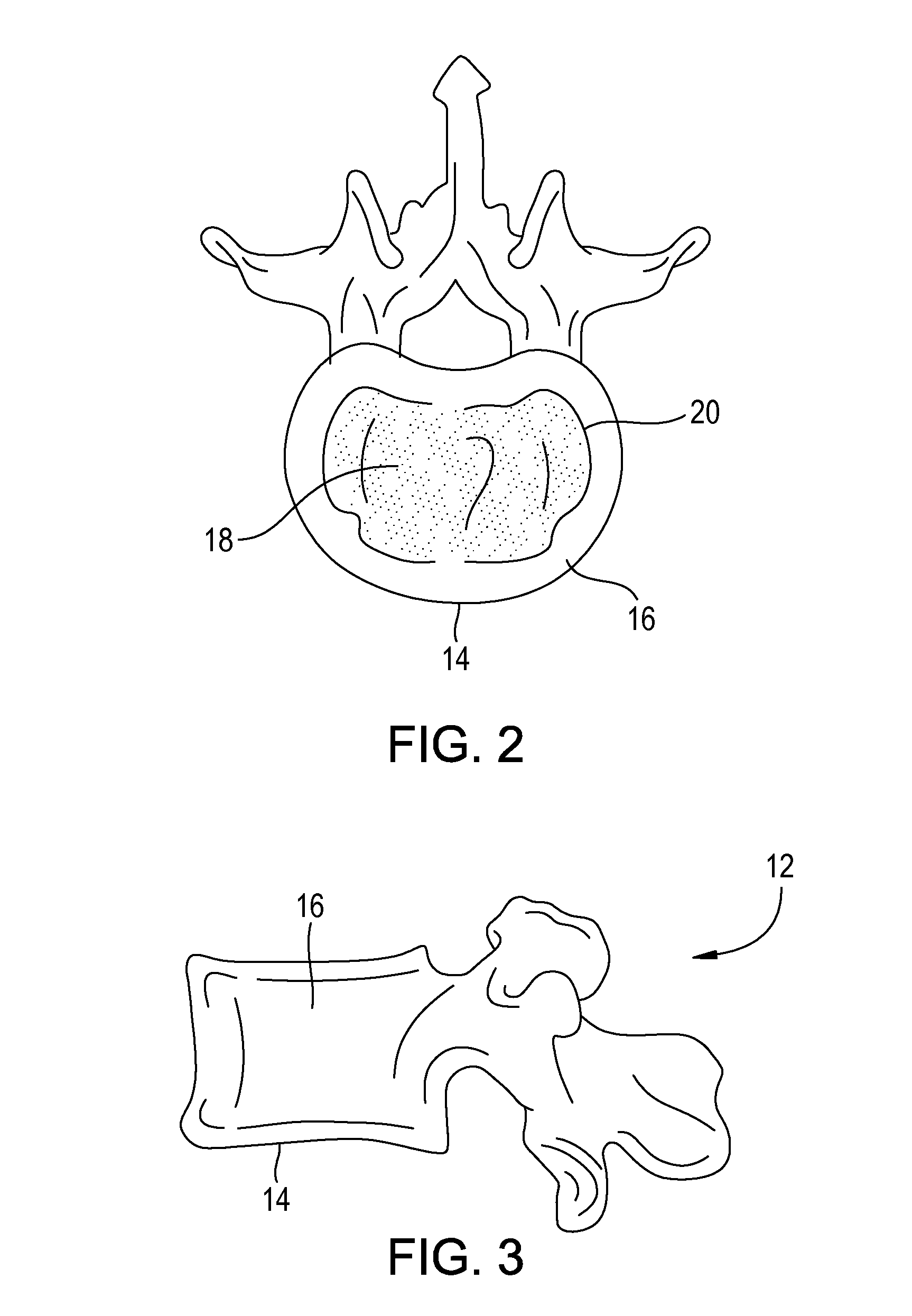 Anterior Lumbar Fusion Method and Device